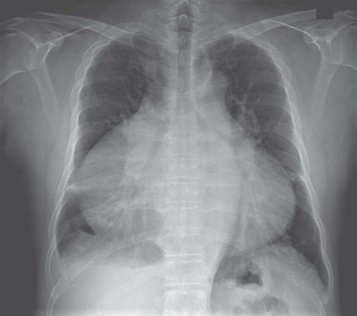 Giant right atrium