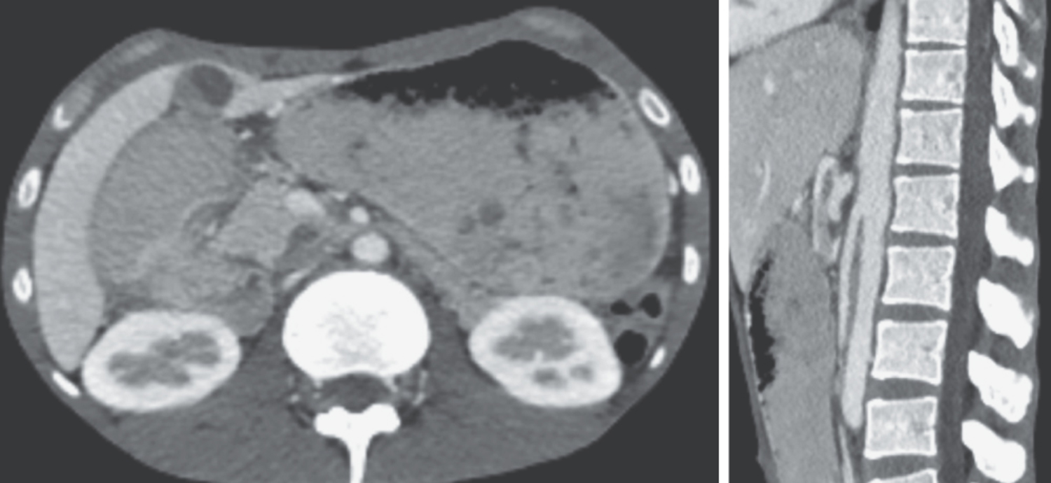 Superior mesenteric artery syndrome