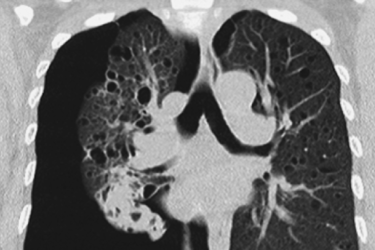 Lymphangioleiomyomatosis