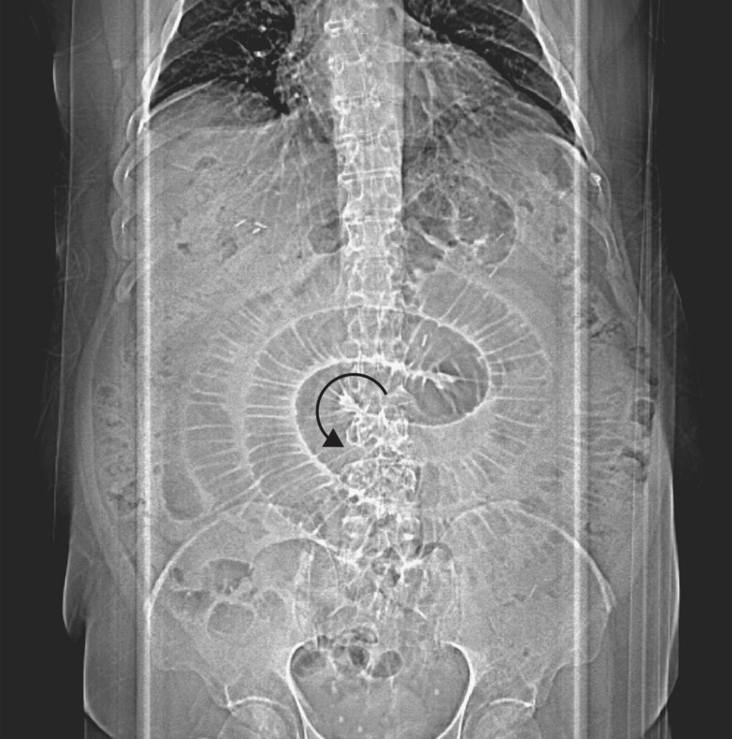 Internal hernia