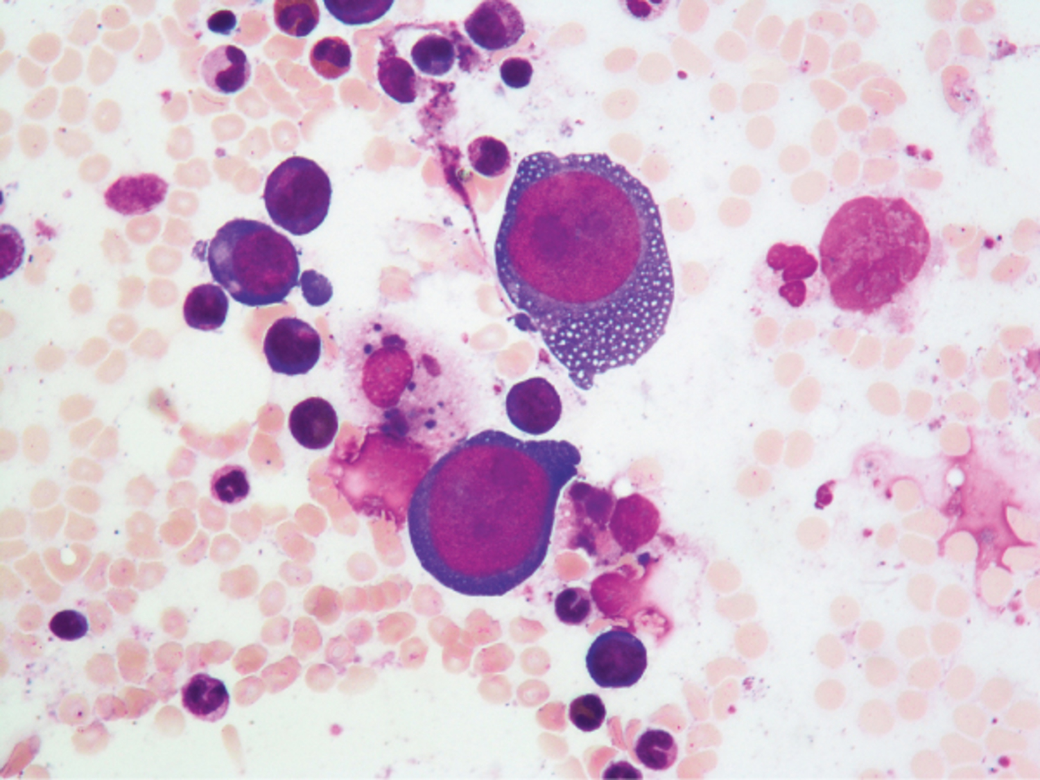 Parvovirus B19 infection