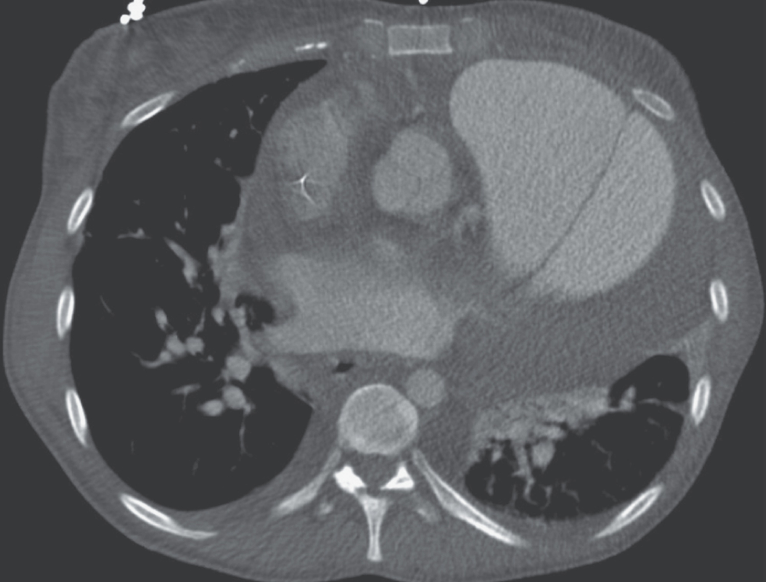 Pulmonary-artery dissection