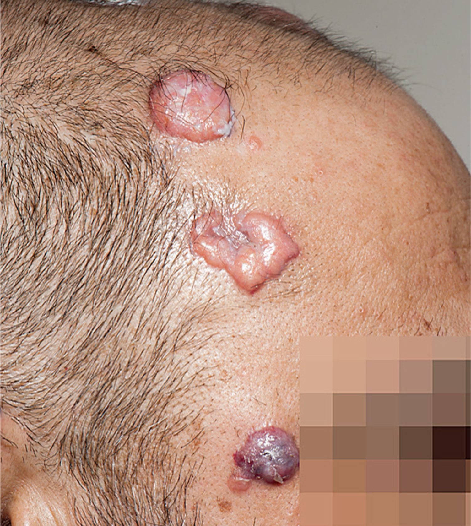 Malakoplakia