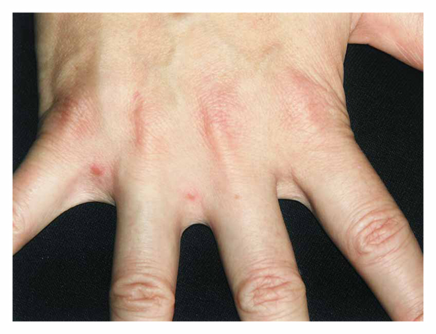 Scabies