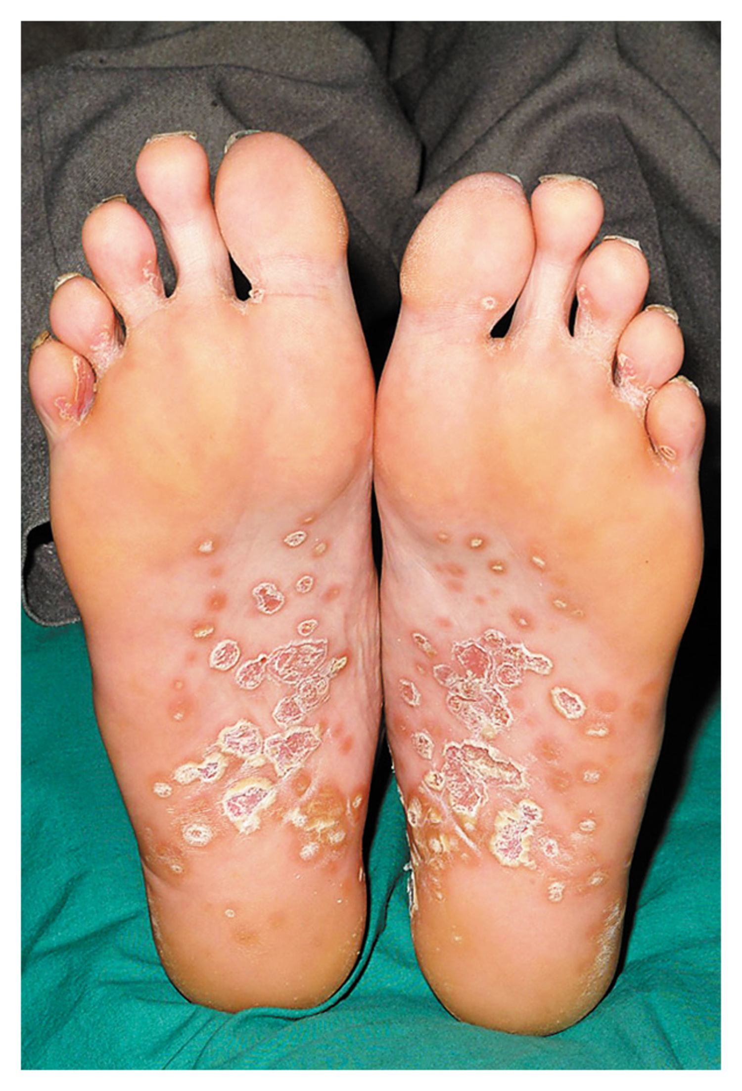 Keratoderma blennorrhagicum