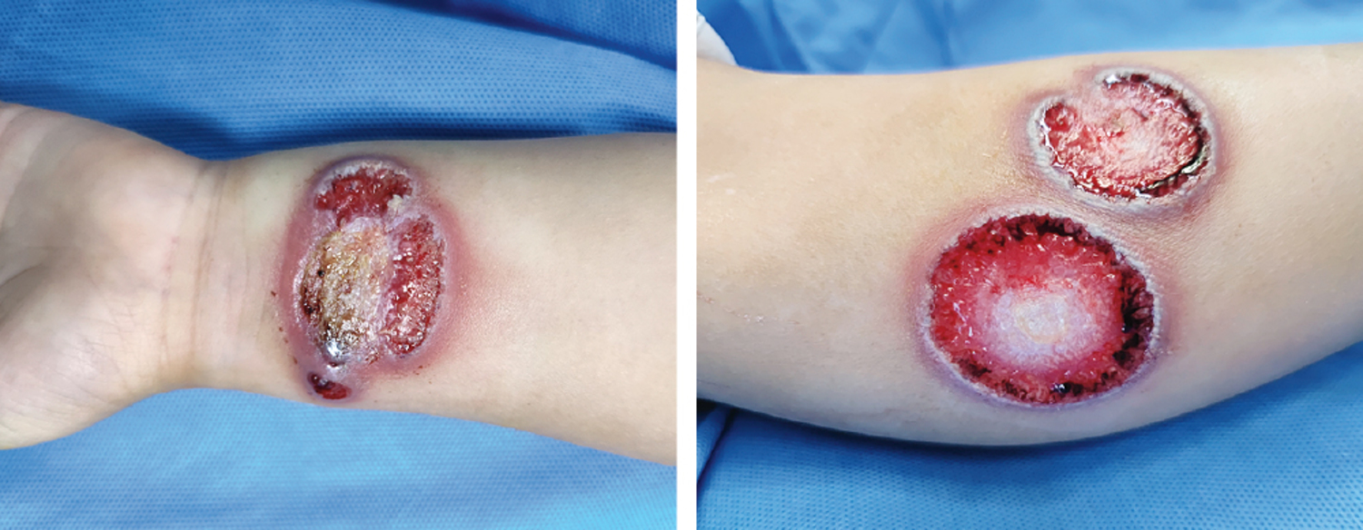 Pyoderma gangrenosum