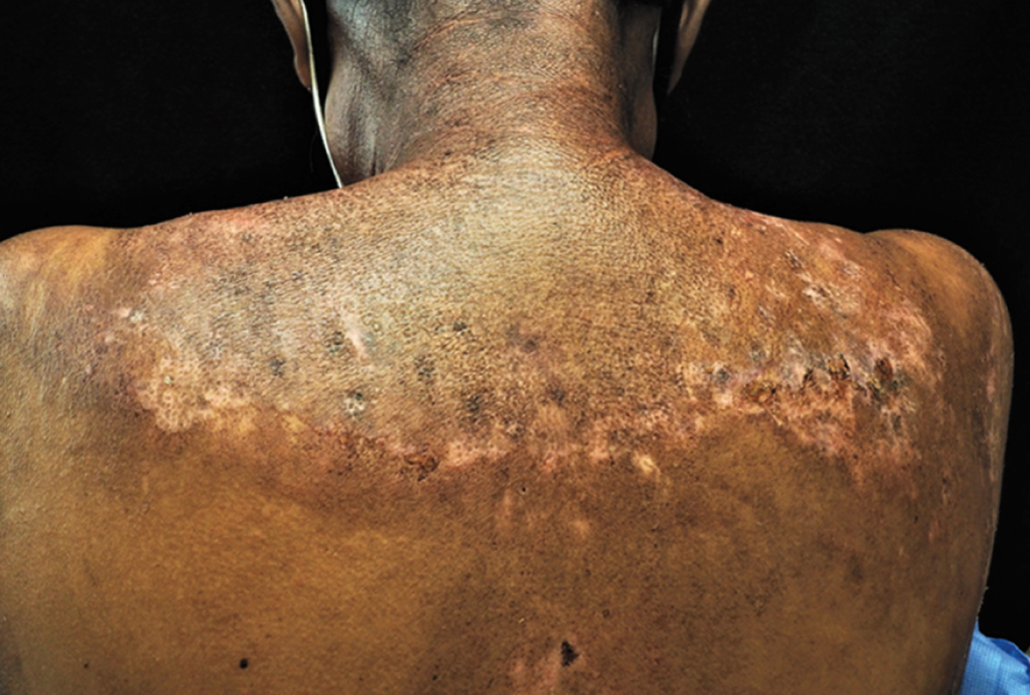 Dermatomyositis