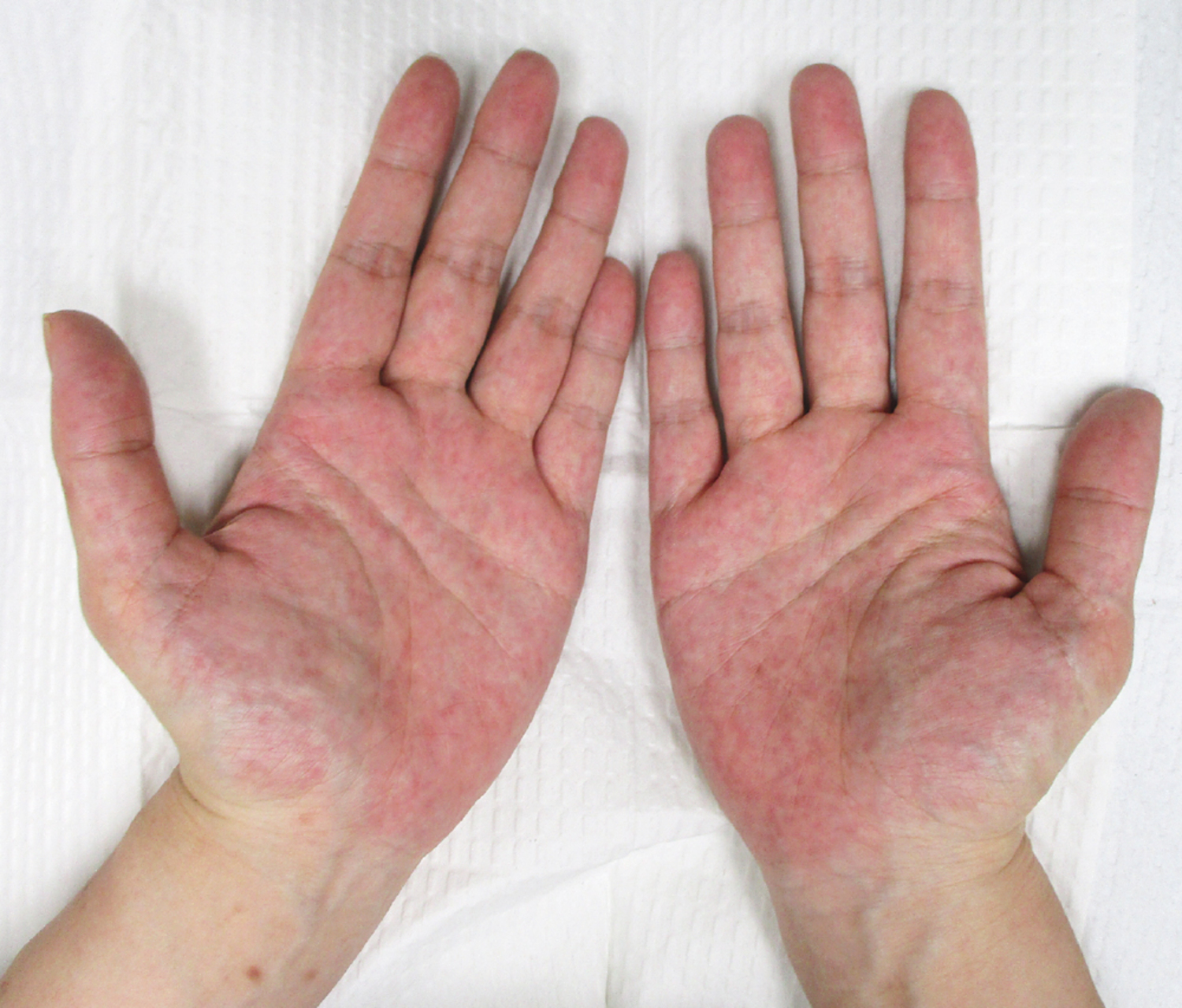 Palmar erythema of pregnancy