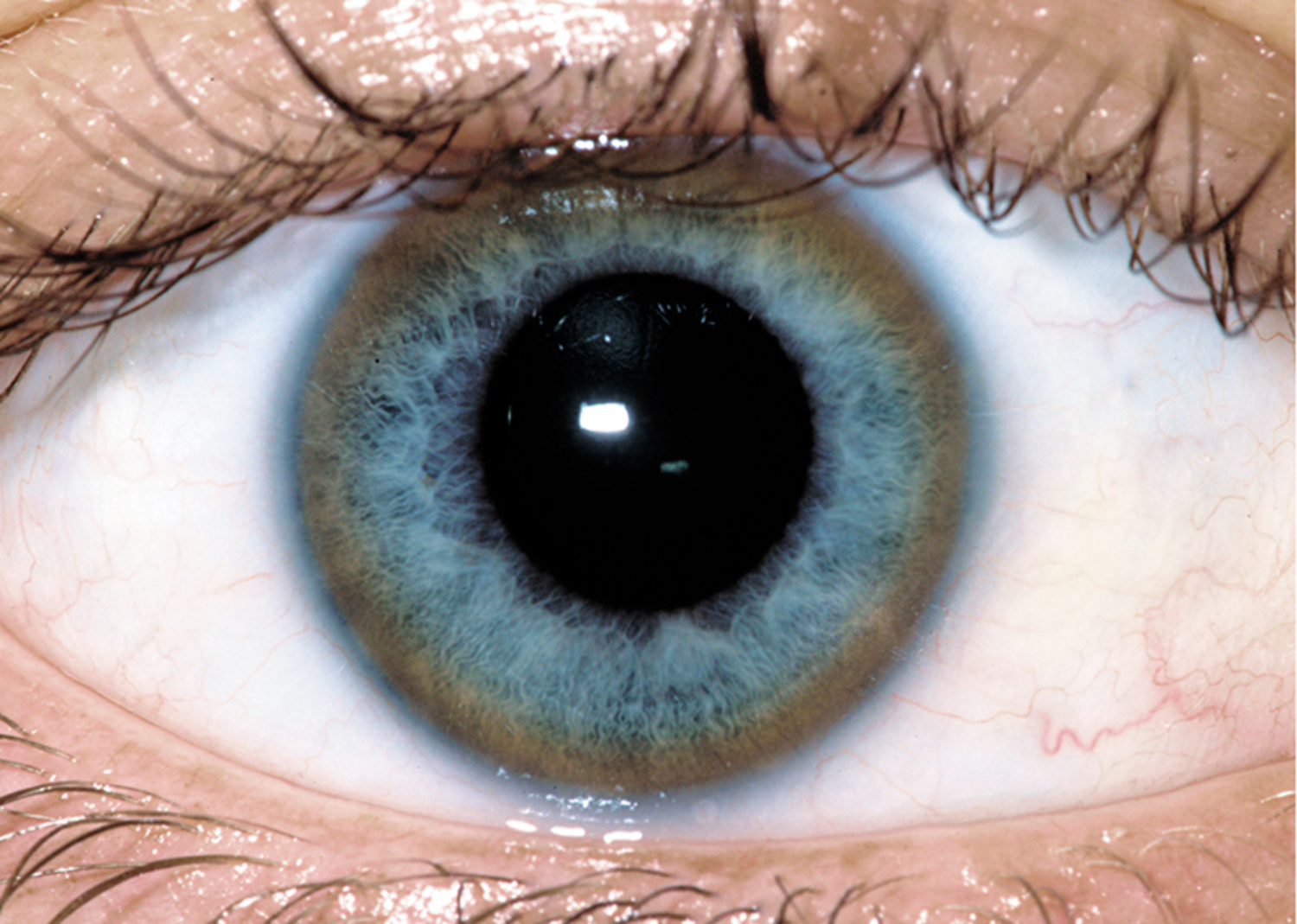 Wilson's disease