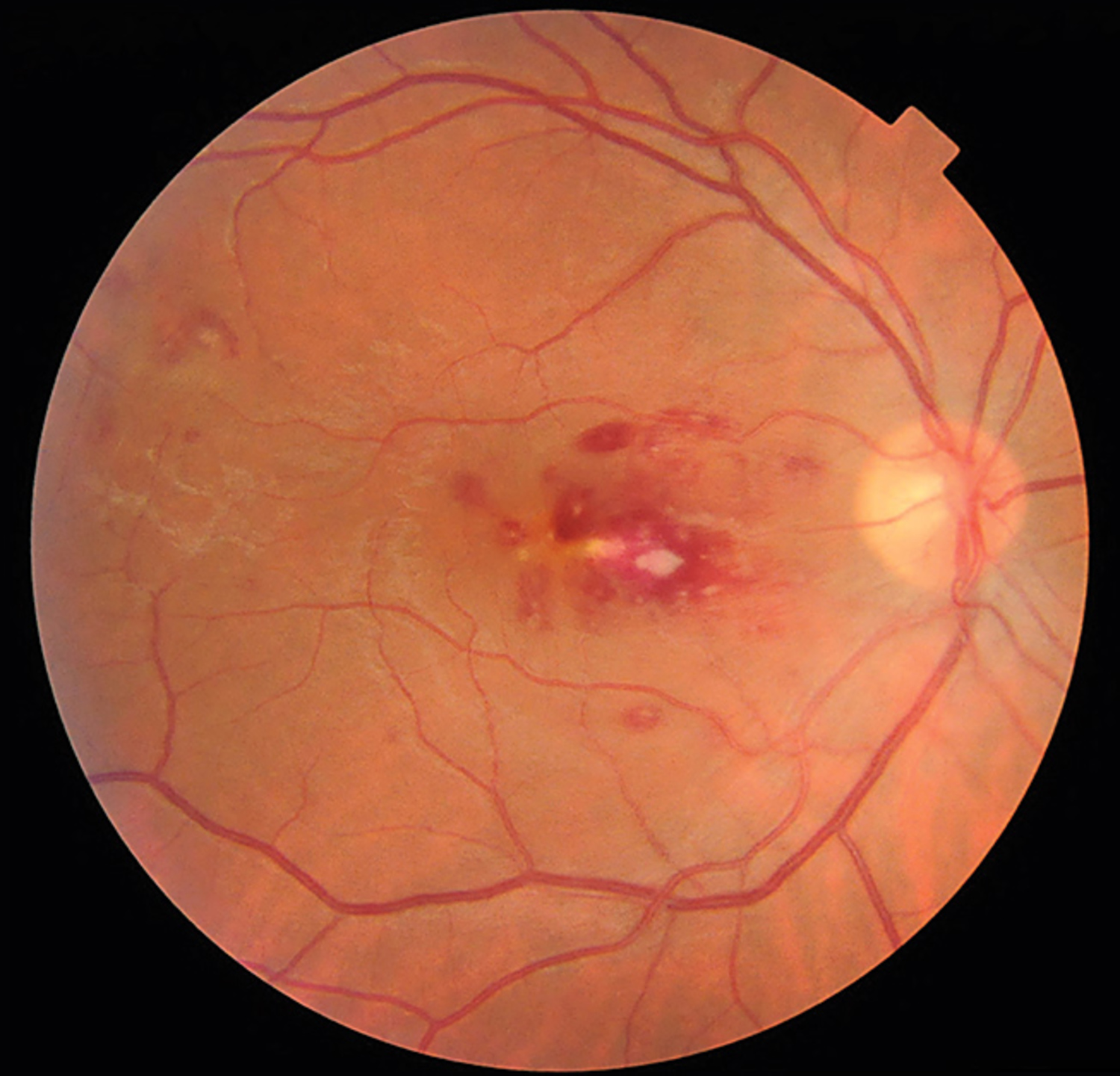 Infective endocarditis