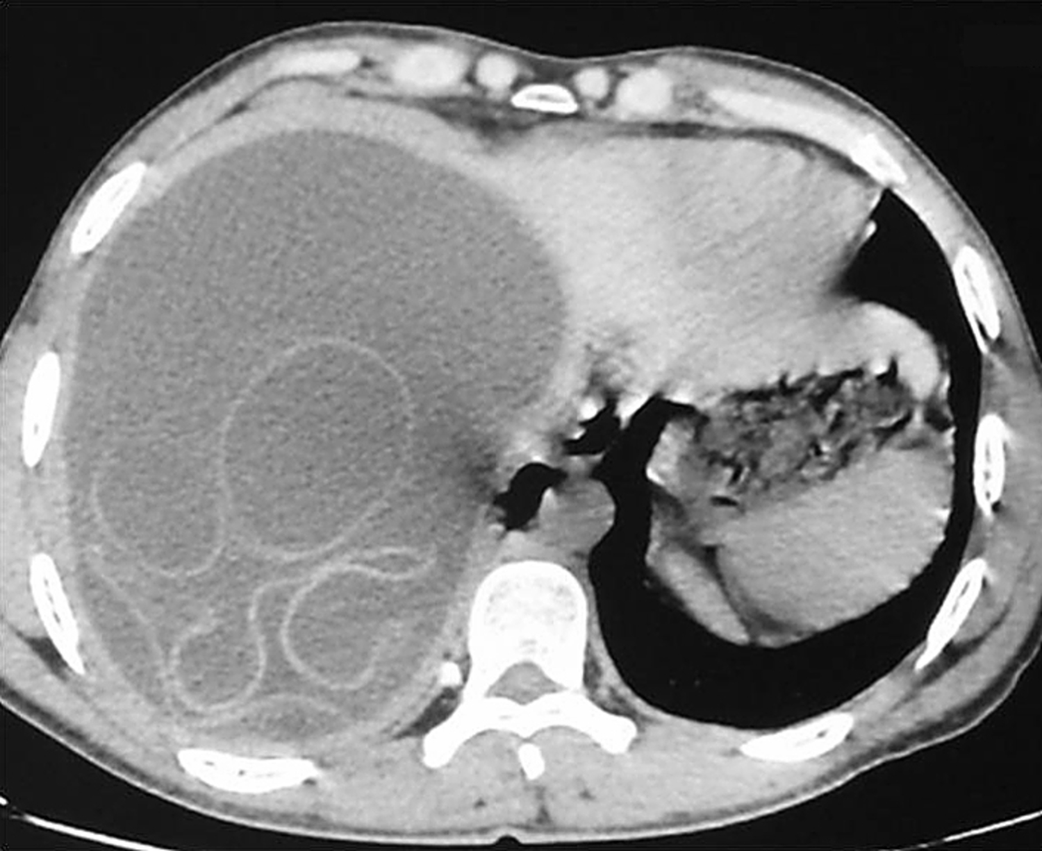 Cystic echinococcosis