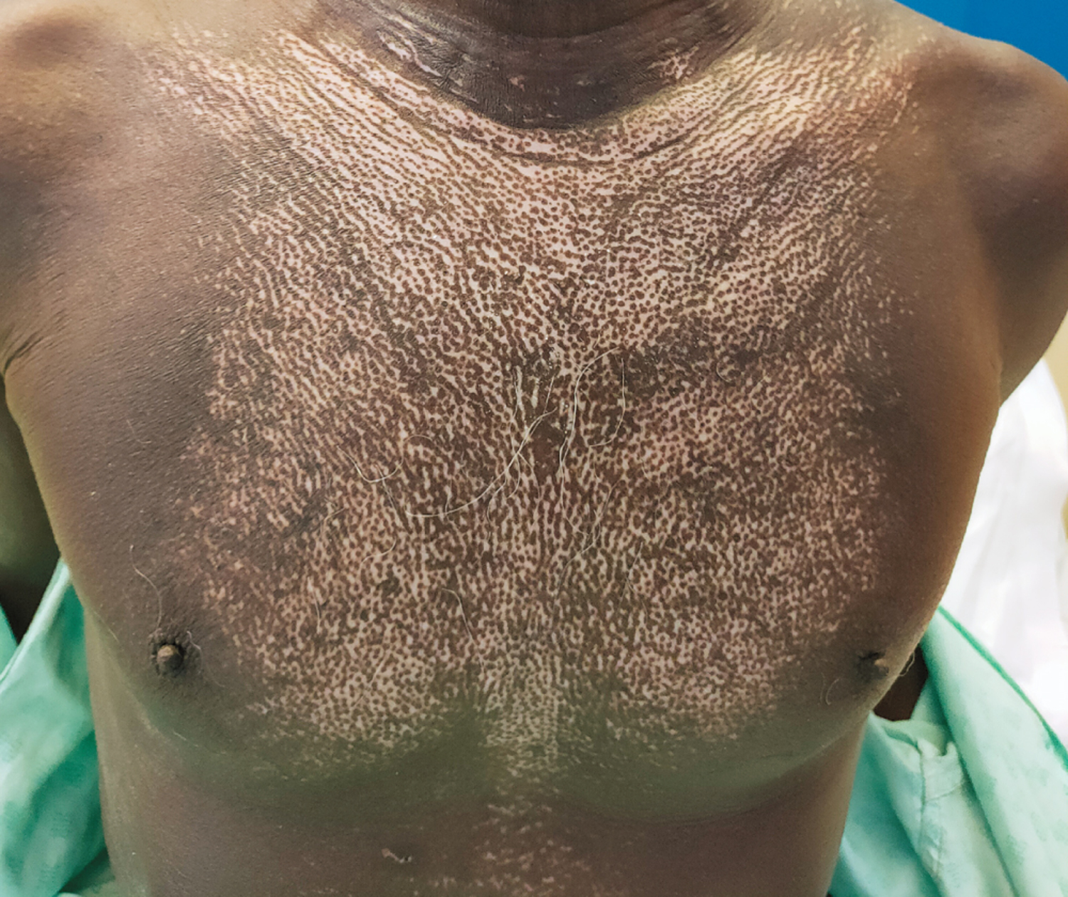 Diffuse cutaneous systemic sclerosis
