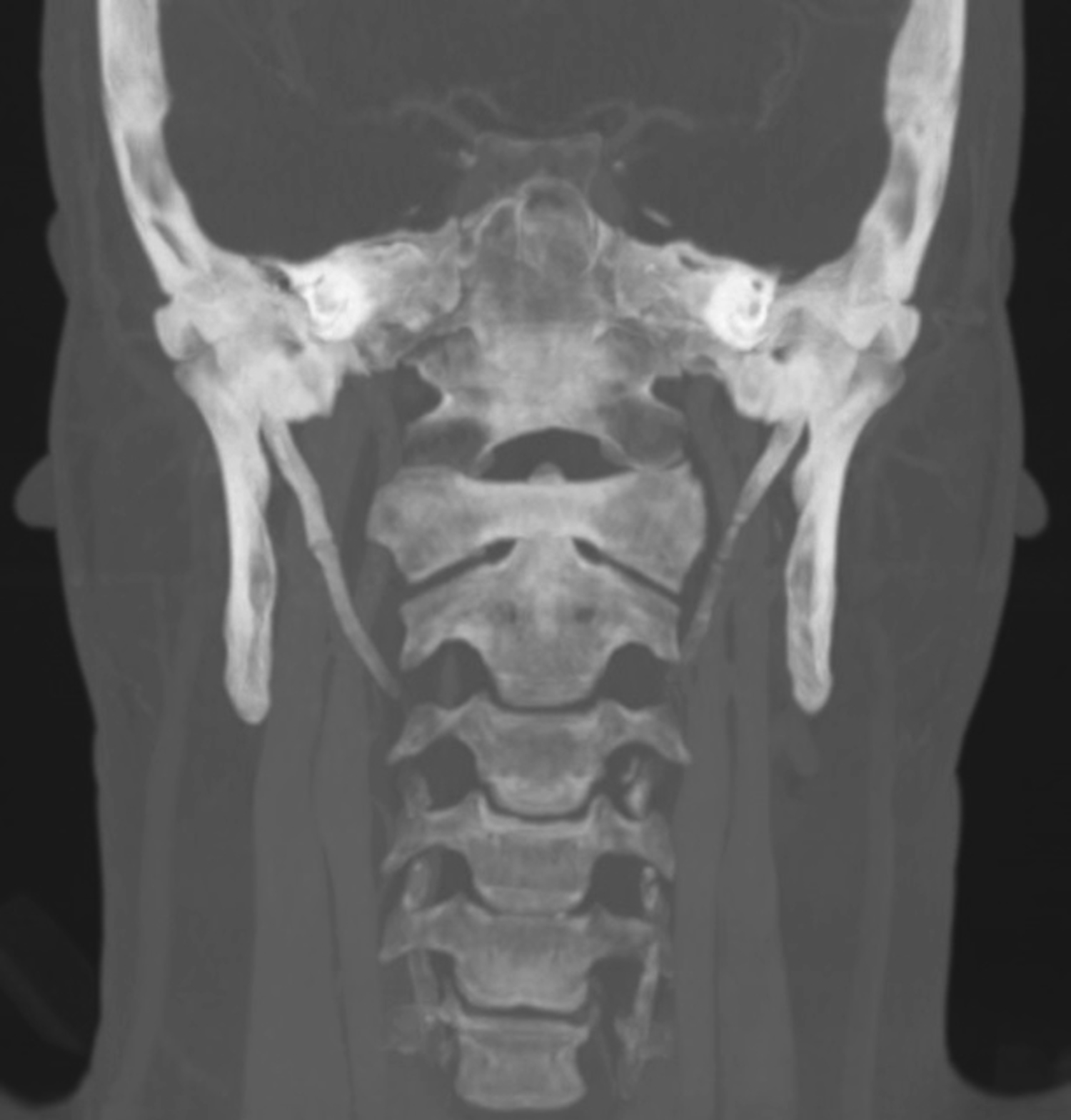 Eagle's syndrome