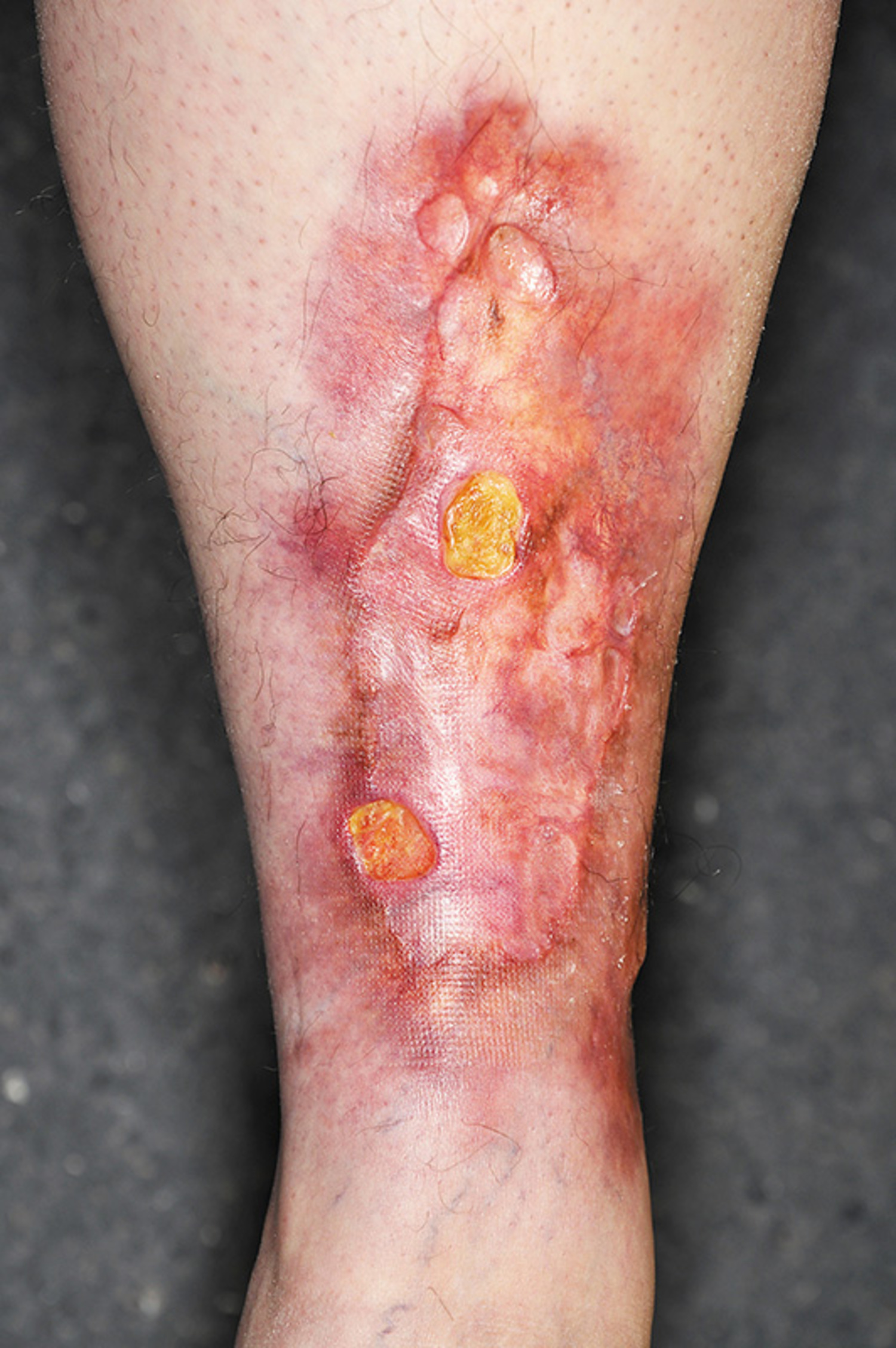 Necrobiosis lipoidica
