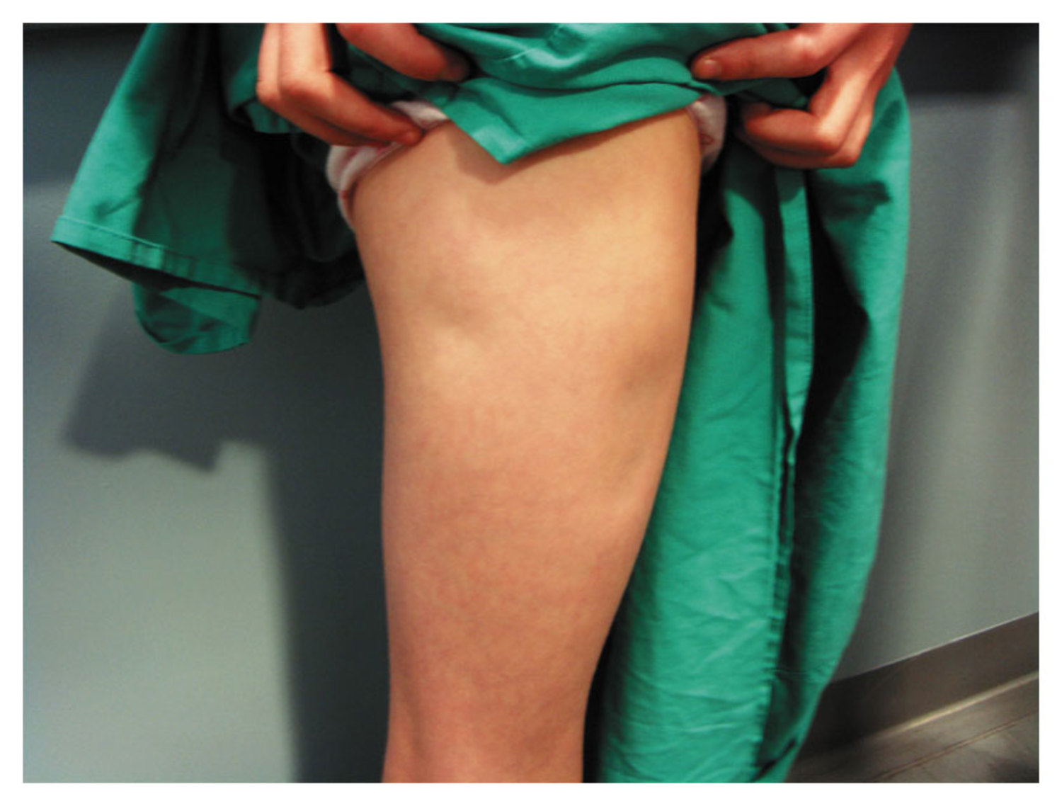 Lipoatrophy