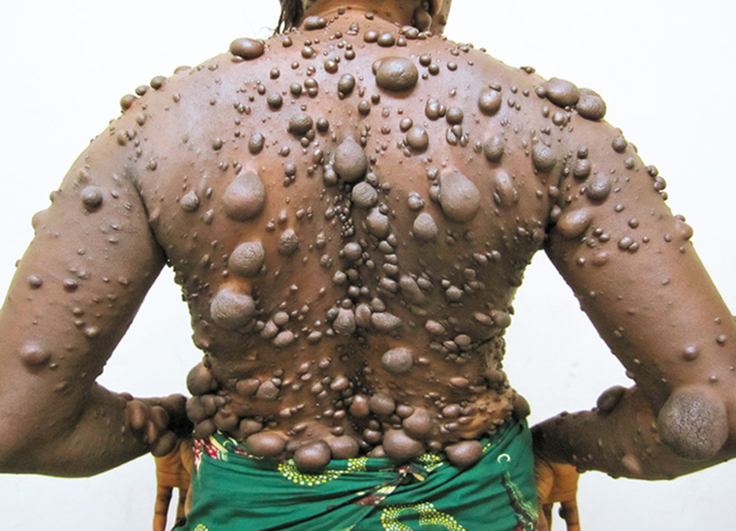 Neurofibromatosis