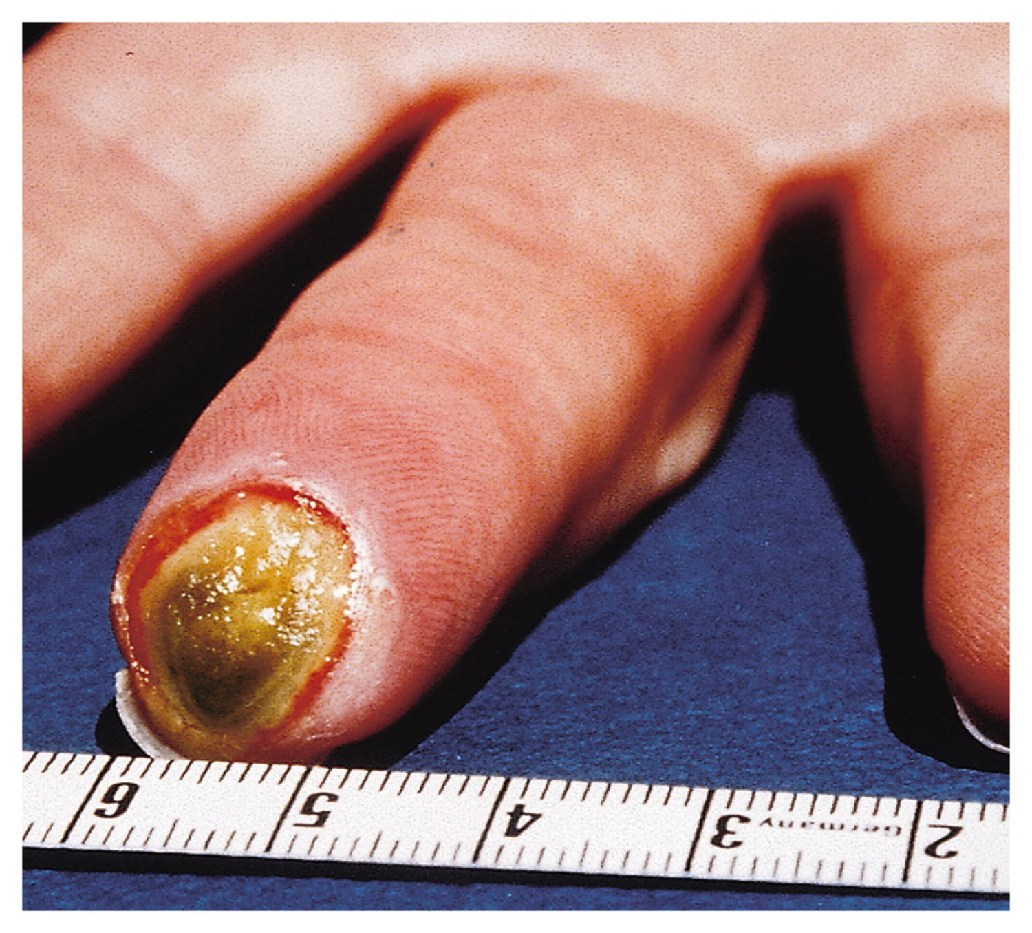 Thromboangiitis obliterans