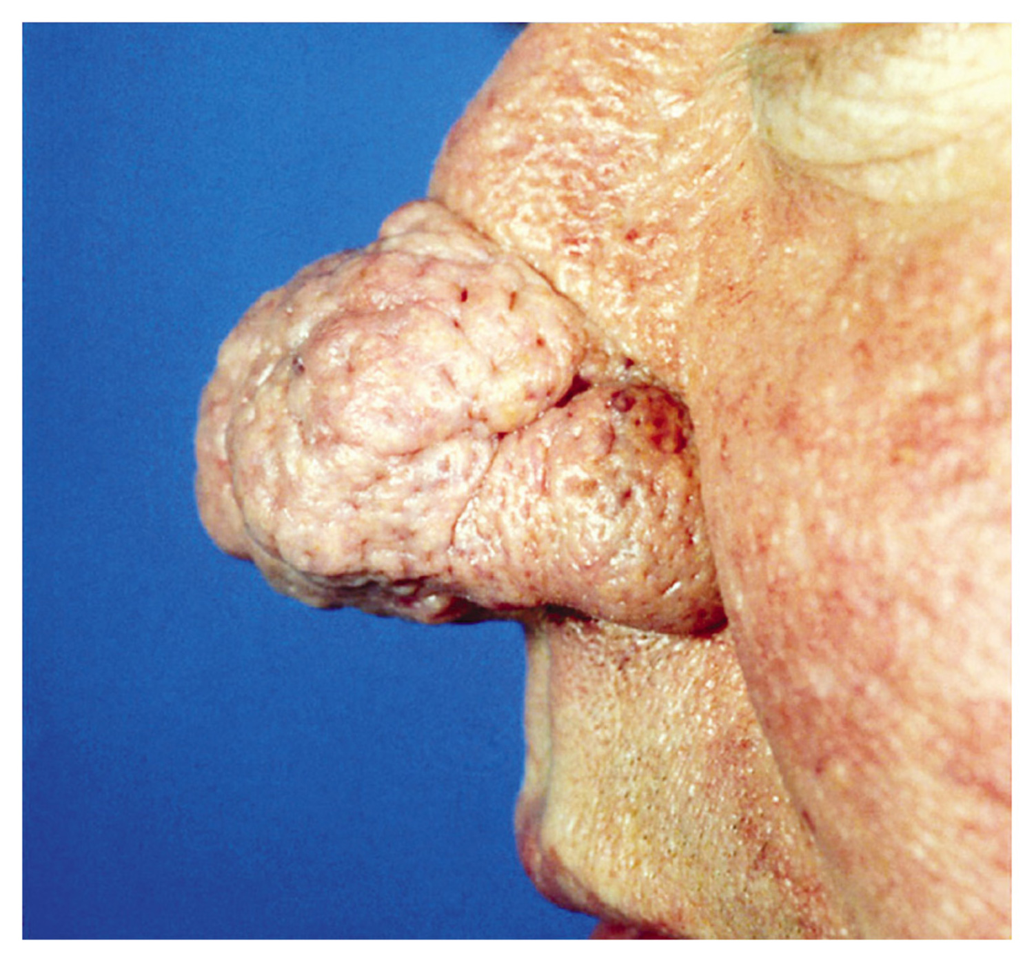 Rhinophyma