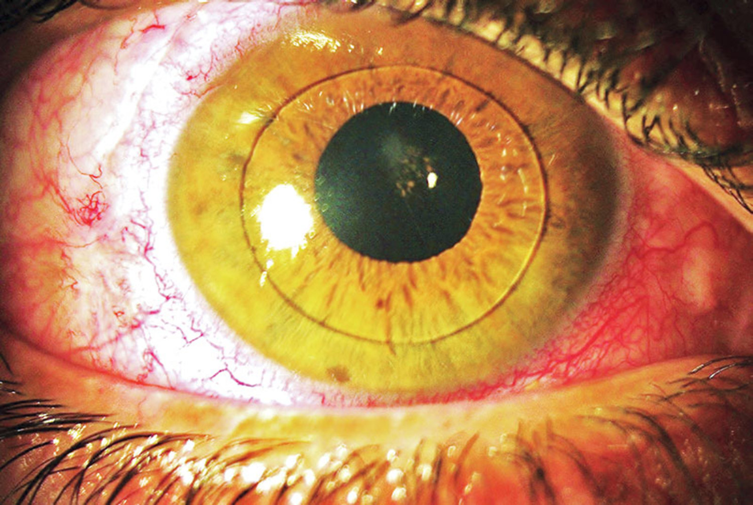 Dislocation of the lens