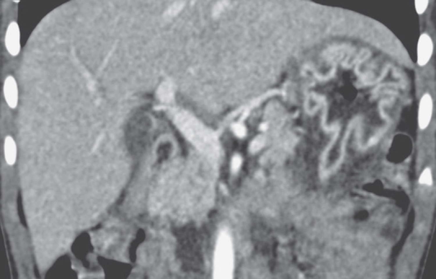 Ménétrier's disease