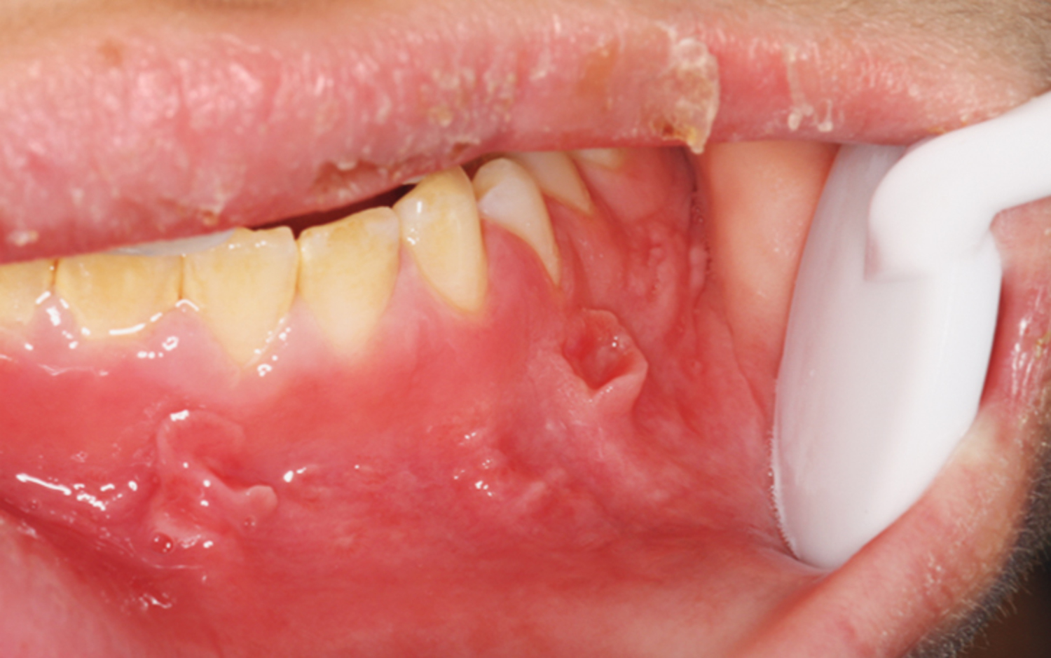 COPD