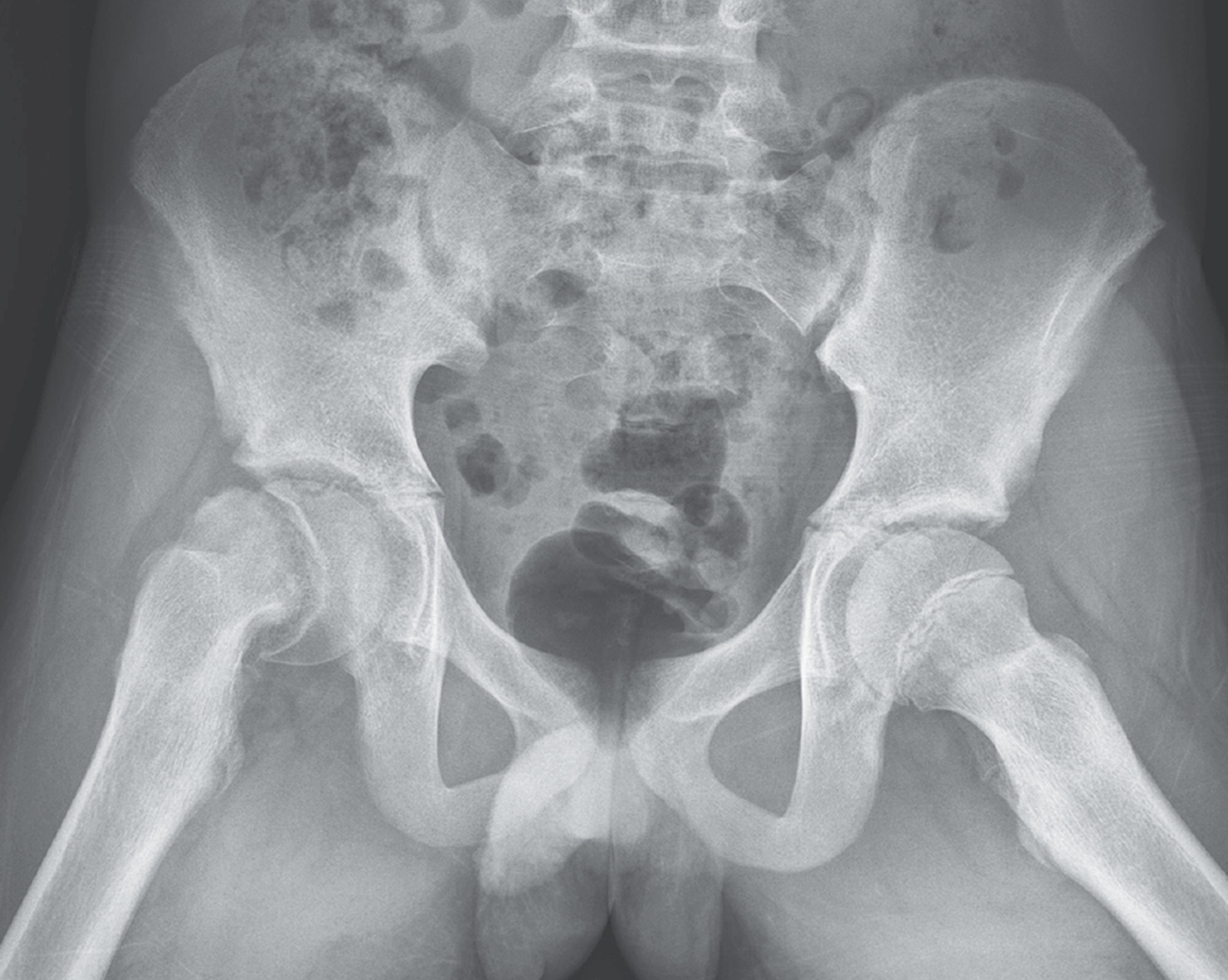 Slipped capital femoral epiphysis
