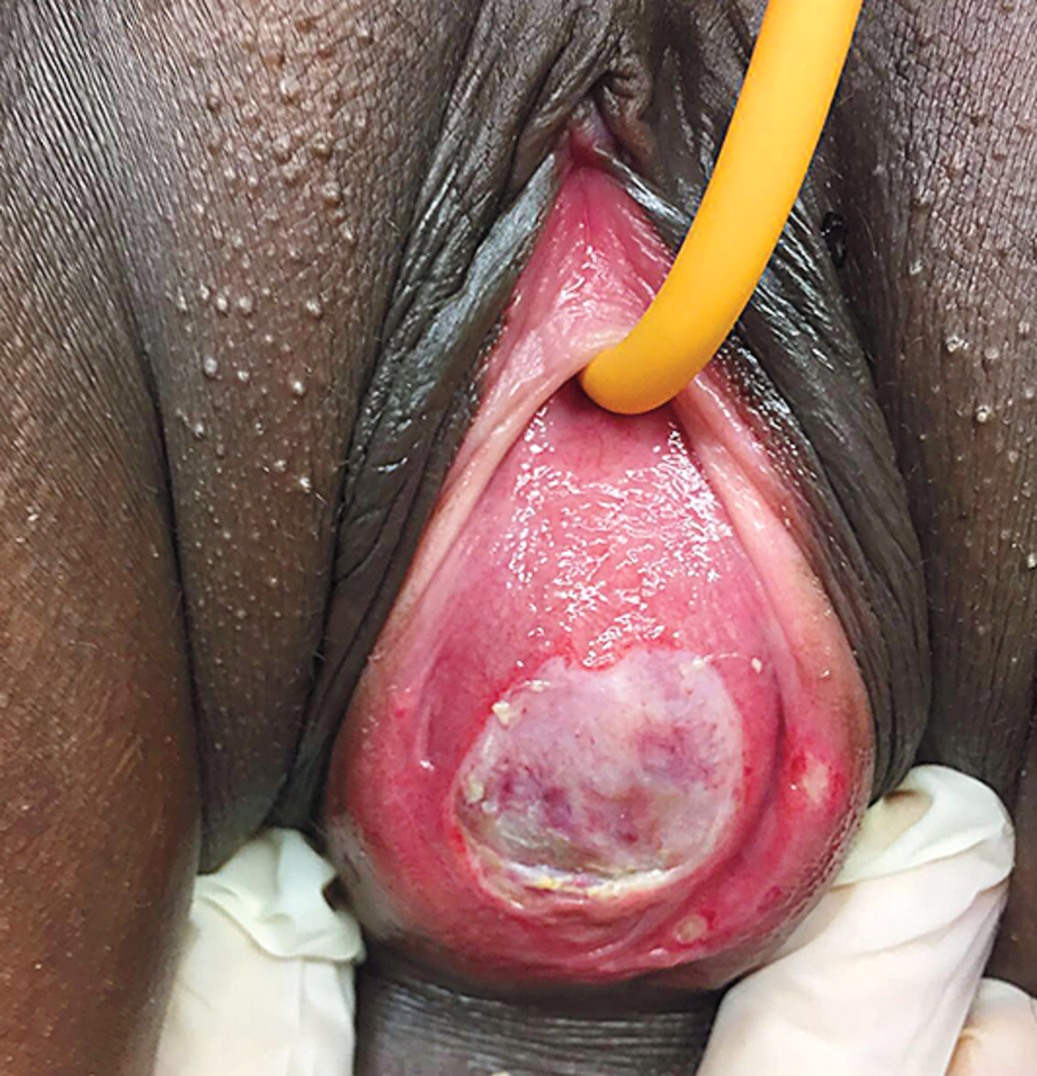 Hematometrocolpos