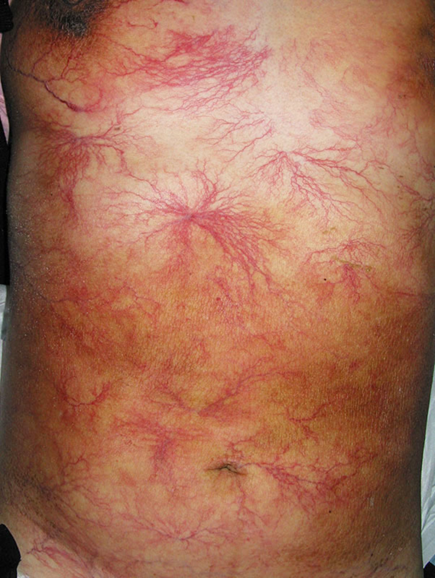 Hemophilia A