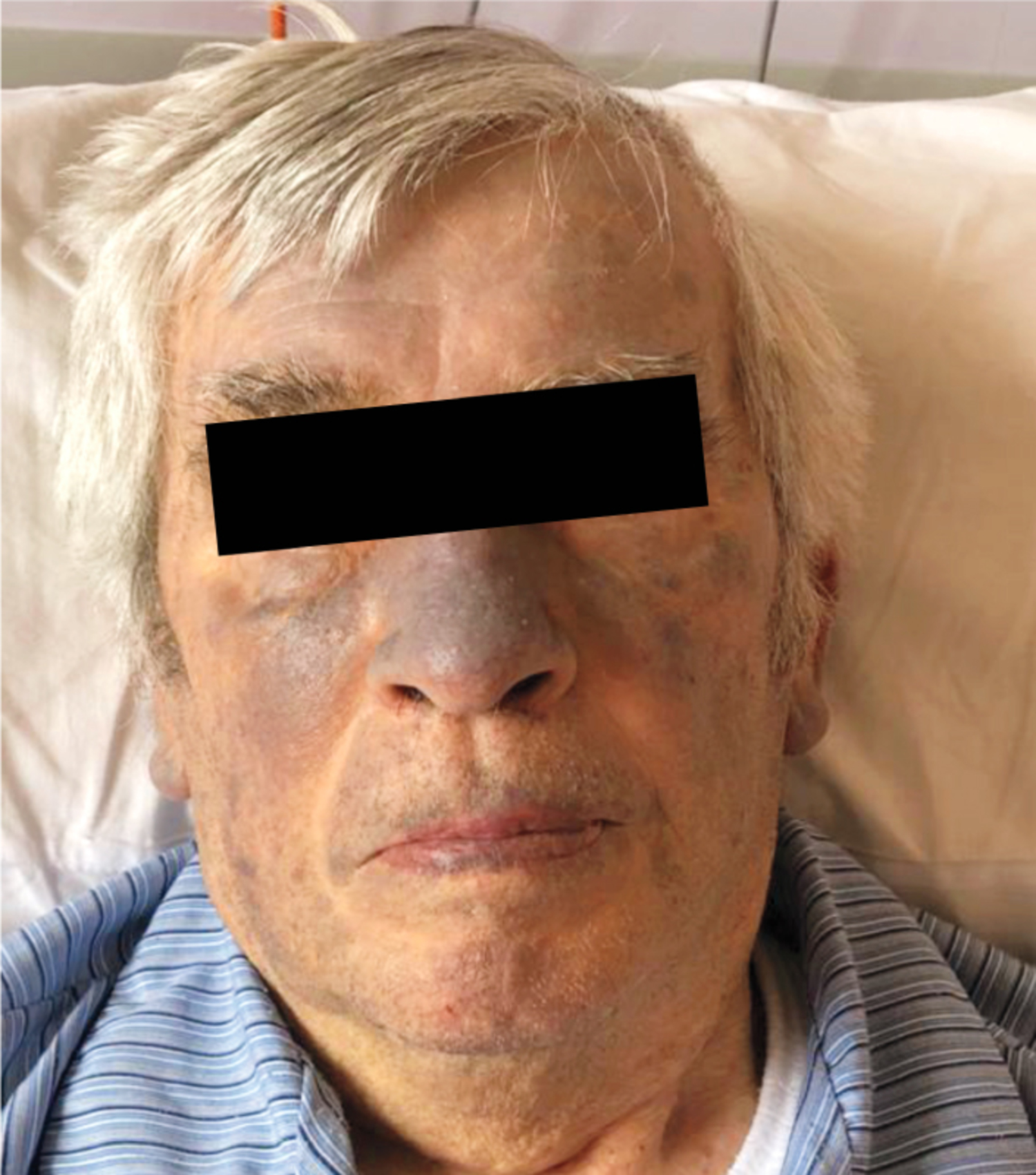 Amiodarone-induced skin discoloration