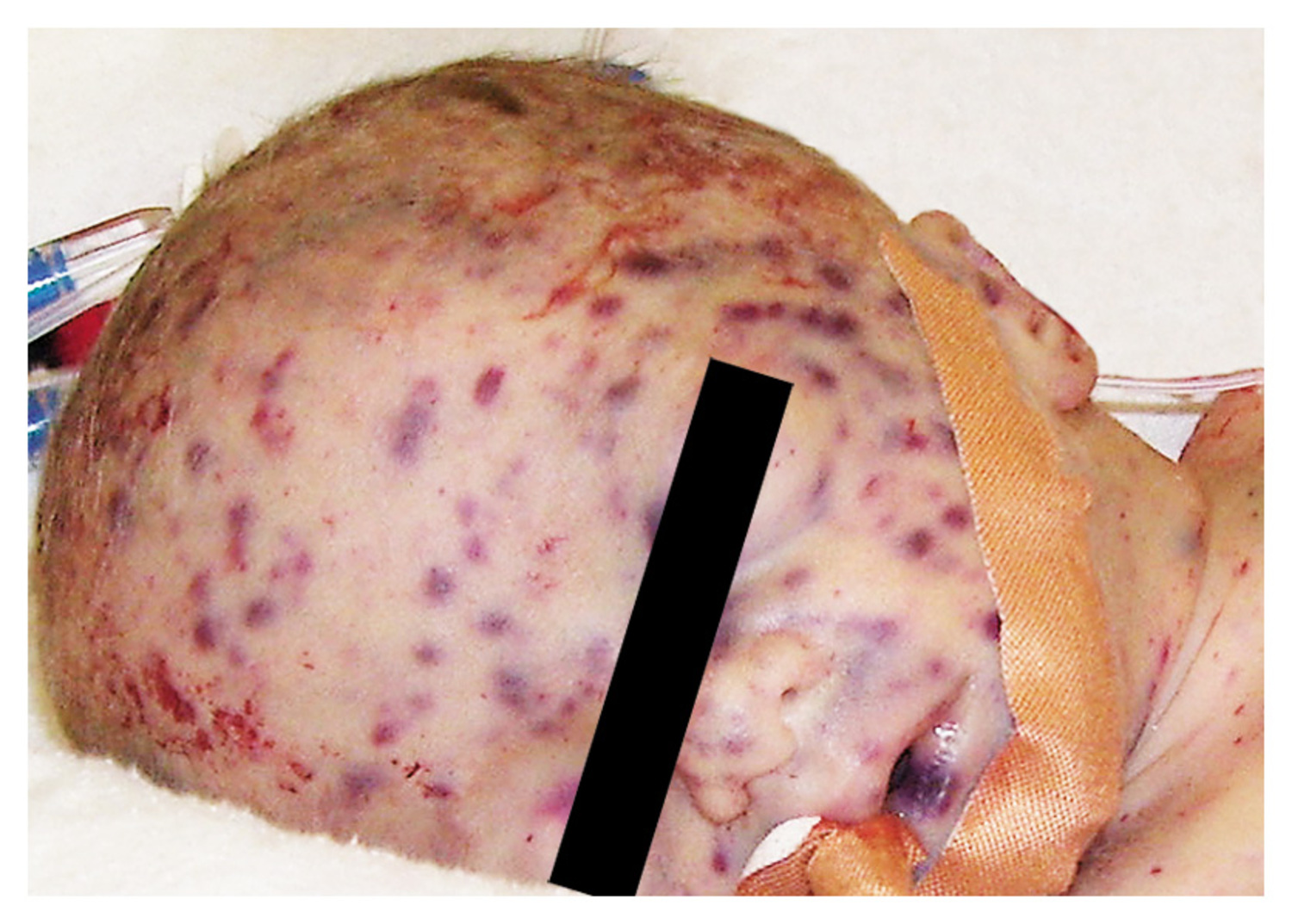 Congenital cytomegalovirus infection