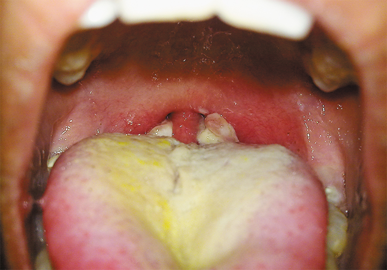 Diphtheria