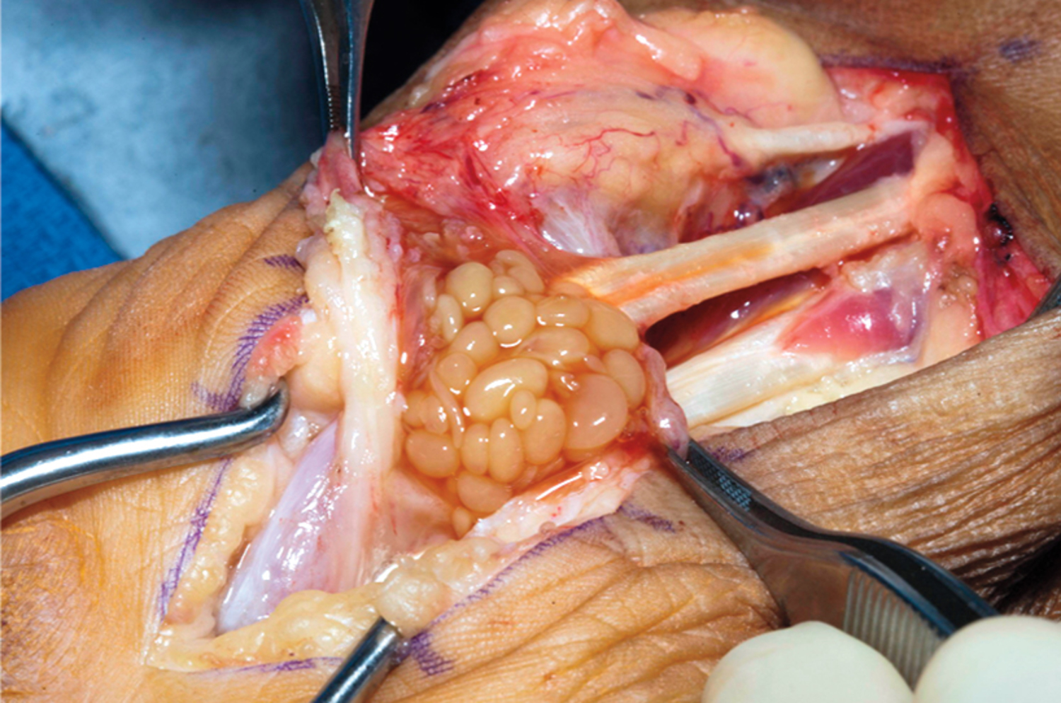 Mycobacterial tenosynovitis due to Mycobacterium avium complex