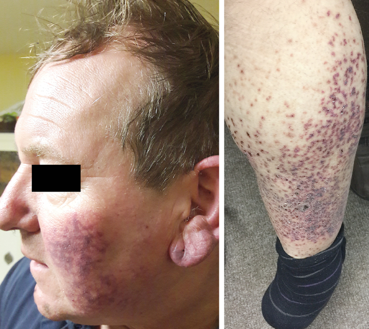 Cryoglobulinemic vasculitis