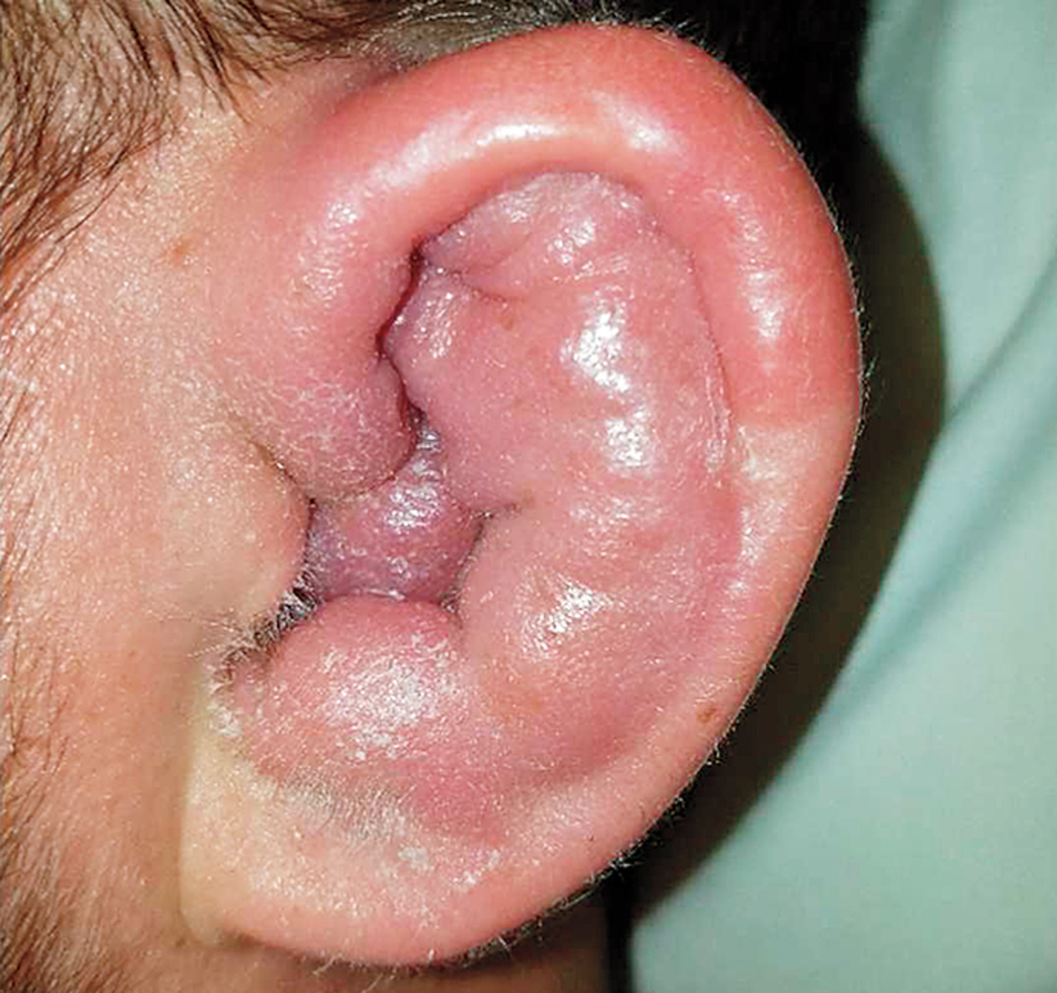 Relapsing polychondritis