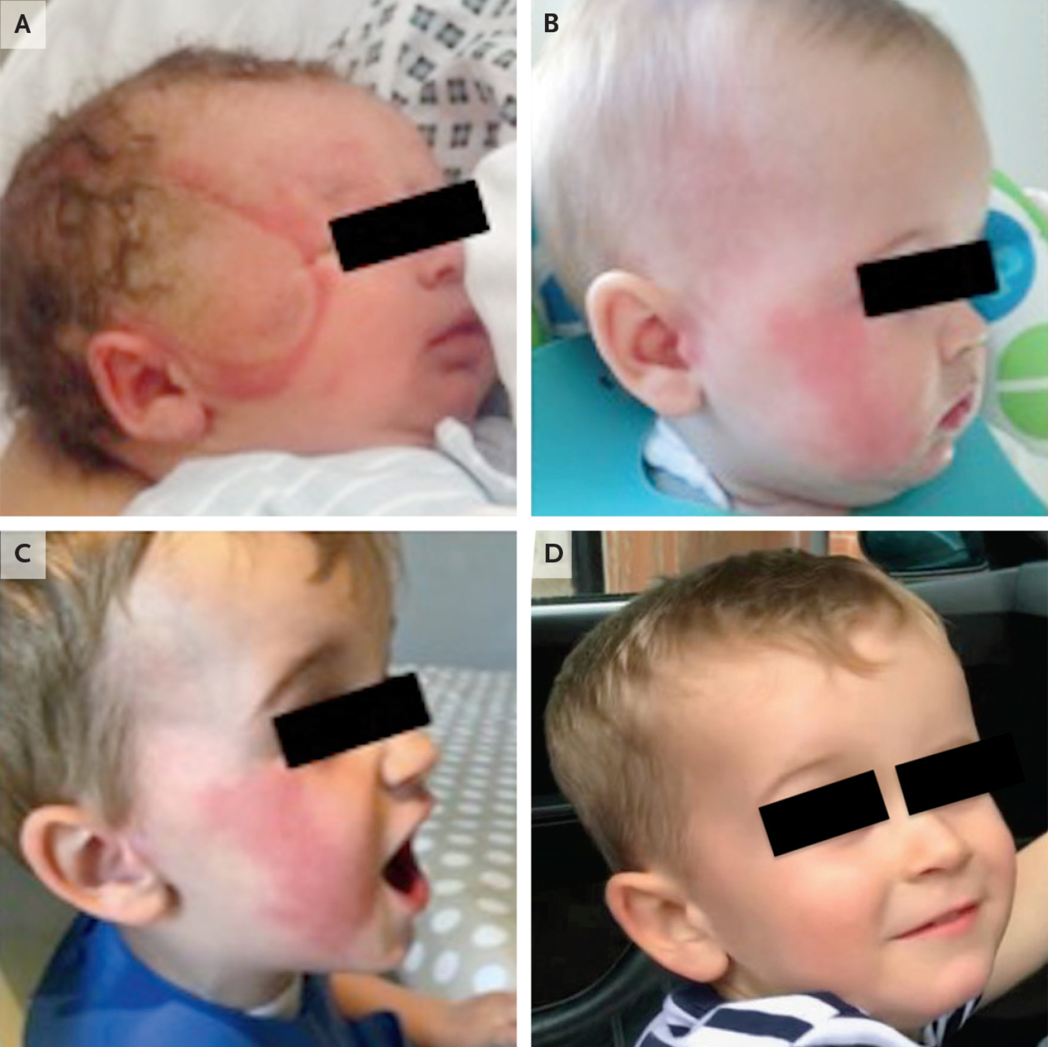 Frey's syndrome