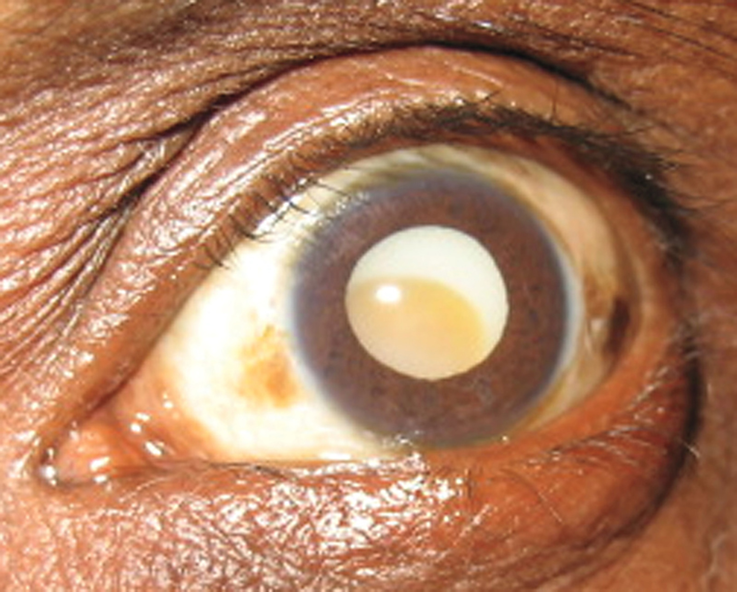 Cataract