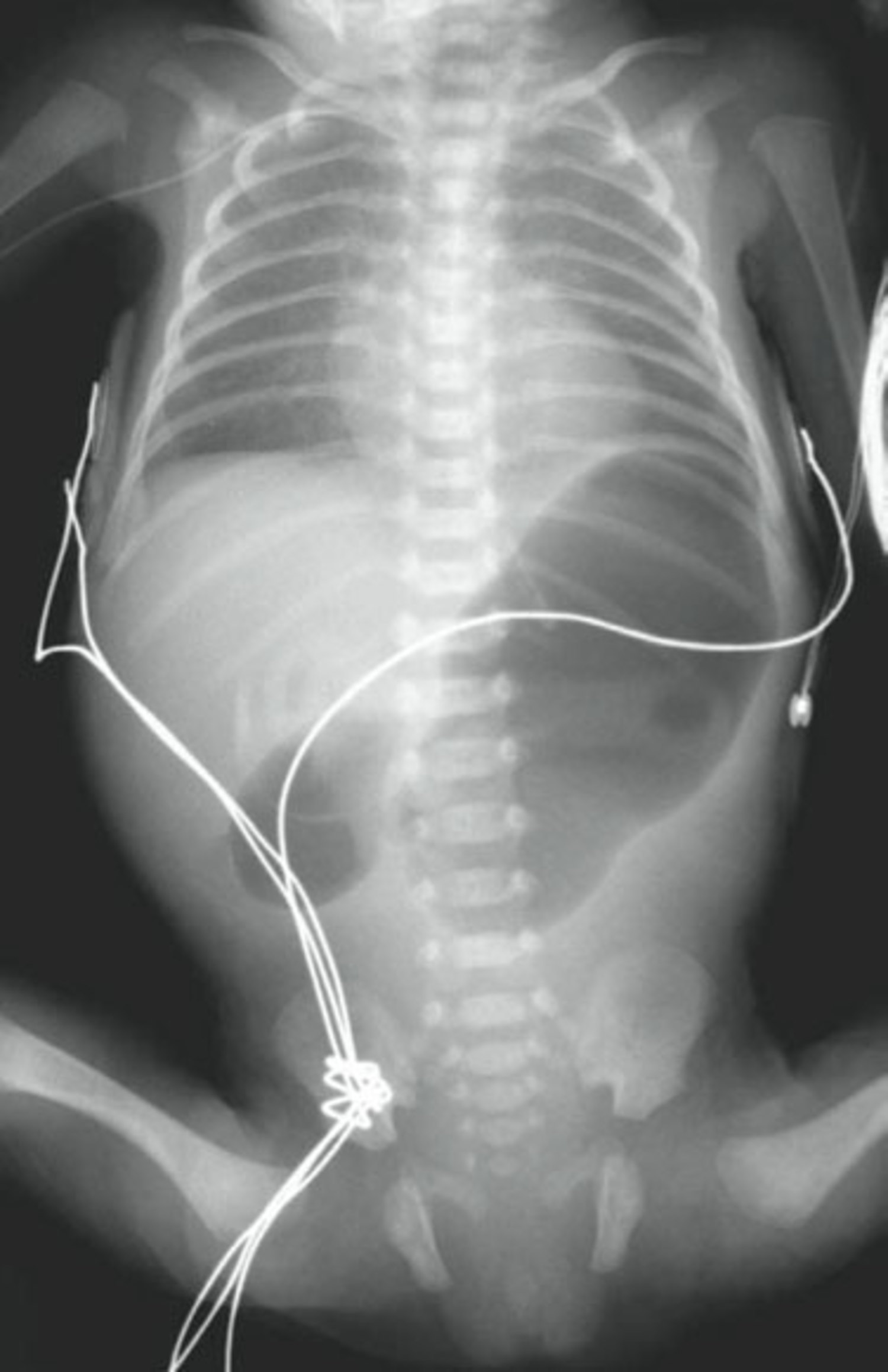 Duodenal atresia