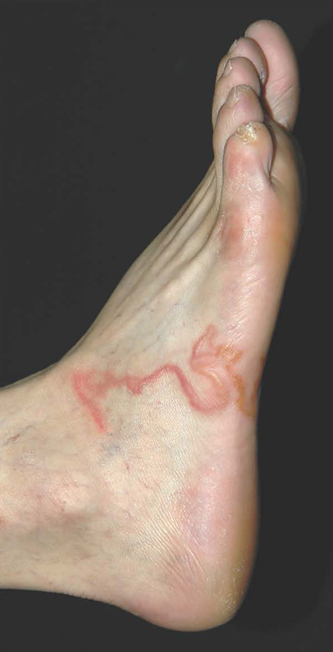 Cutaneous larva migrans