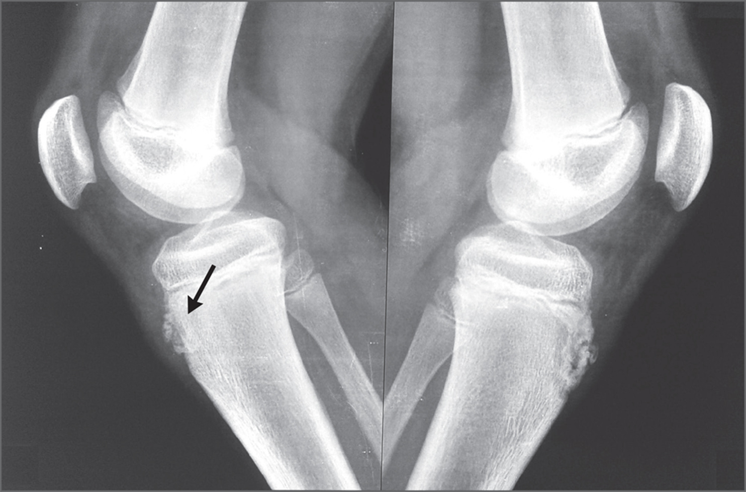 Osgood–Schlatter disease