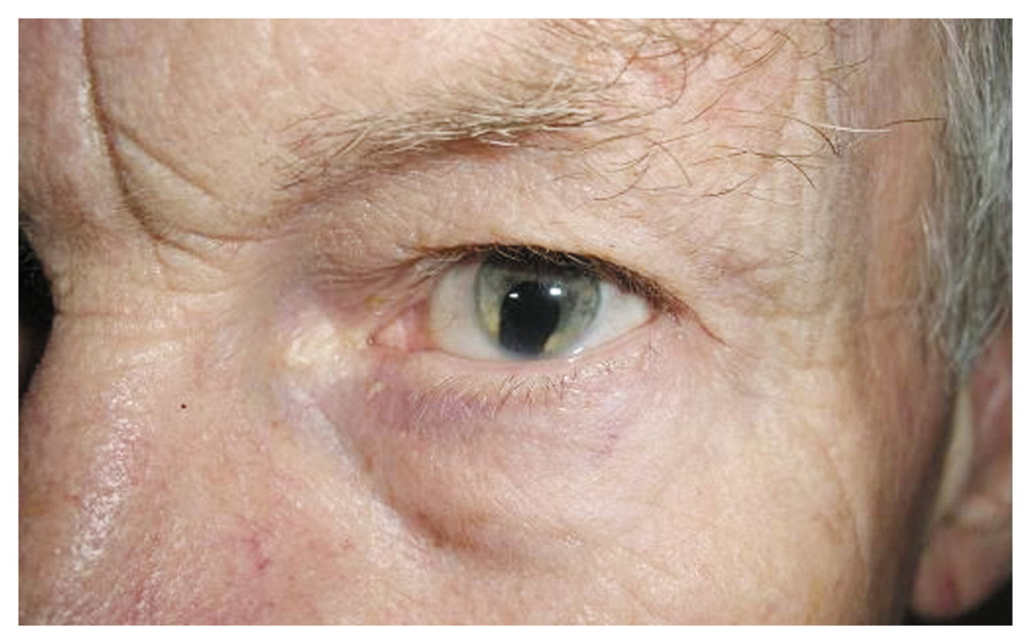 Coloboma