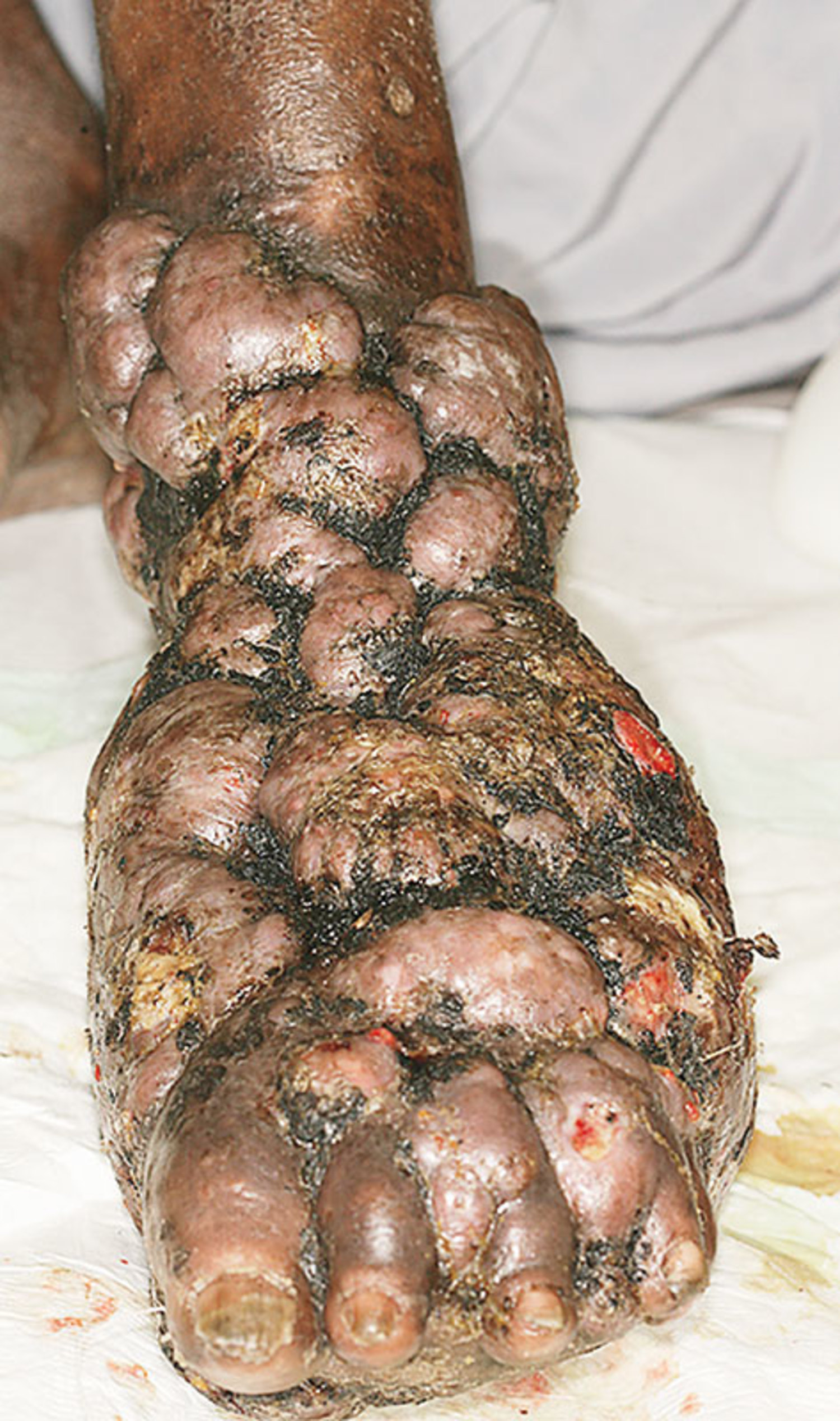 Actinomycetoma