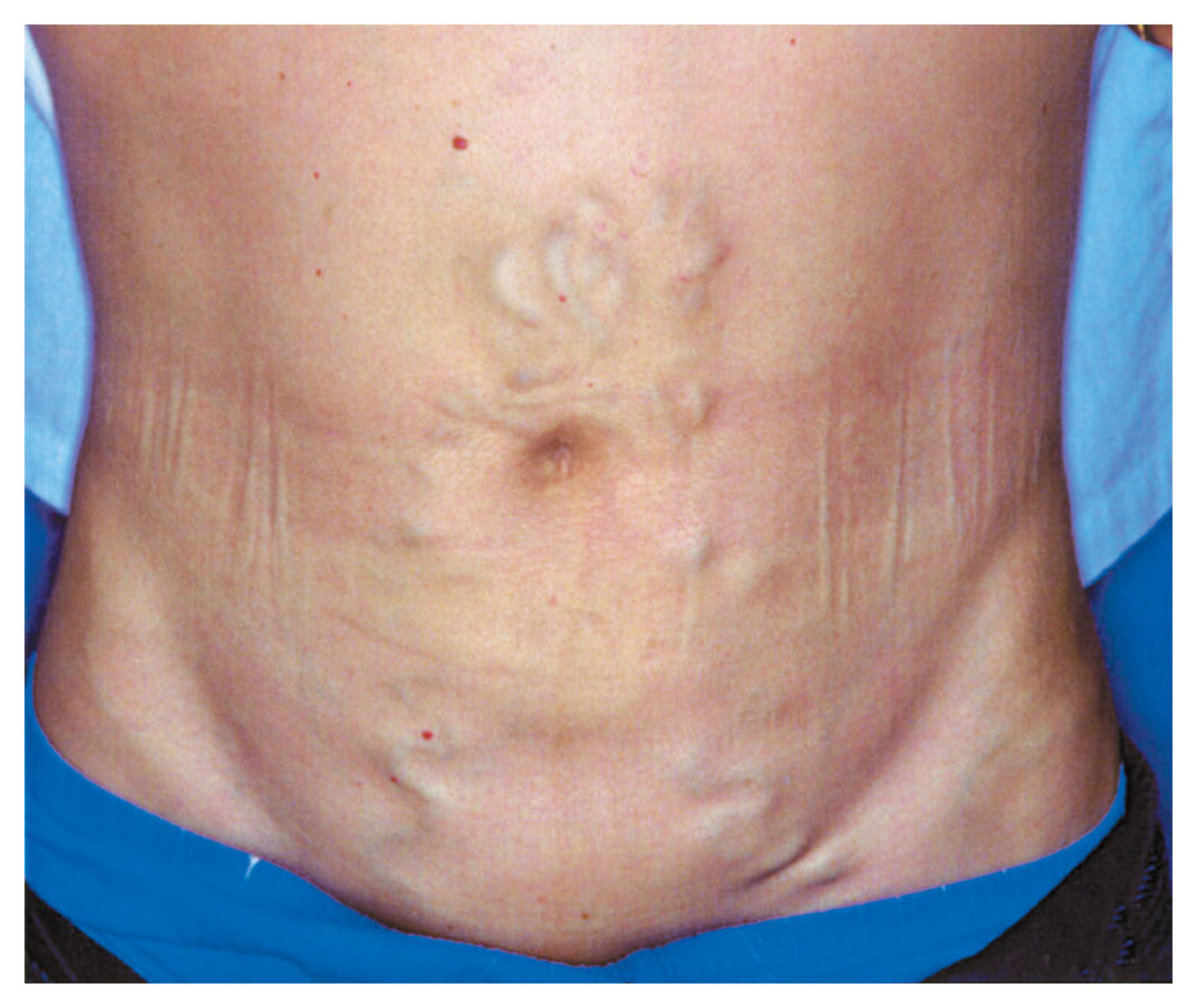 Portal hypertension