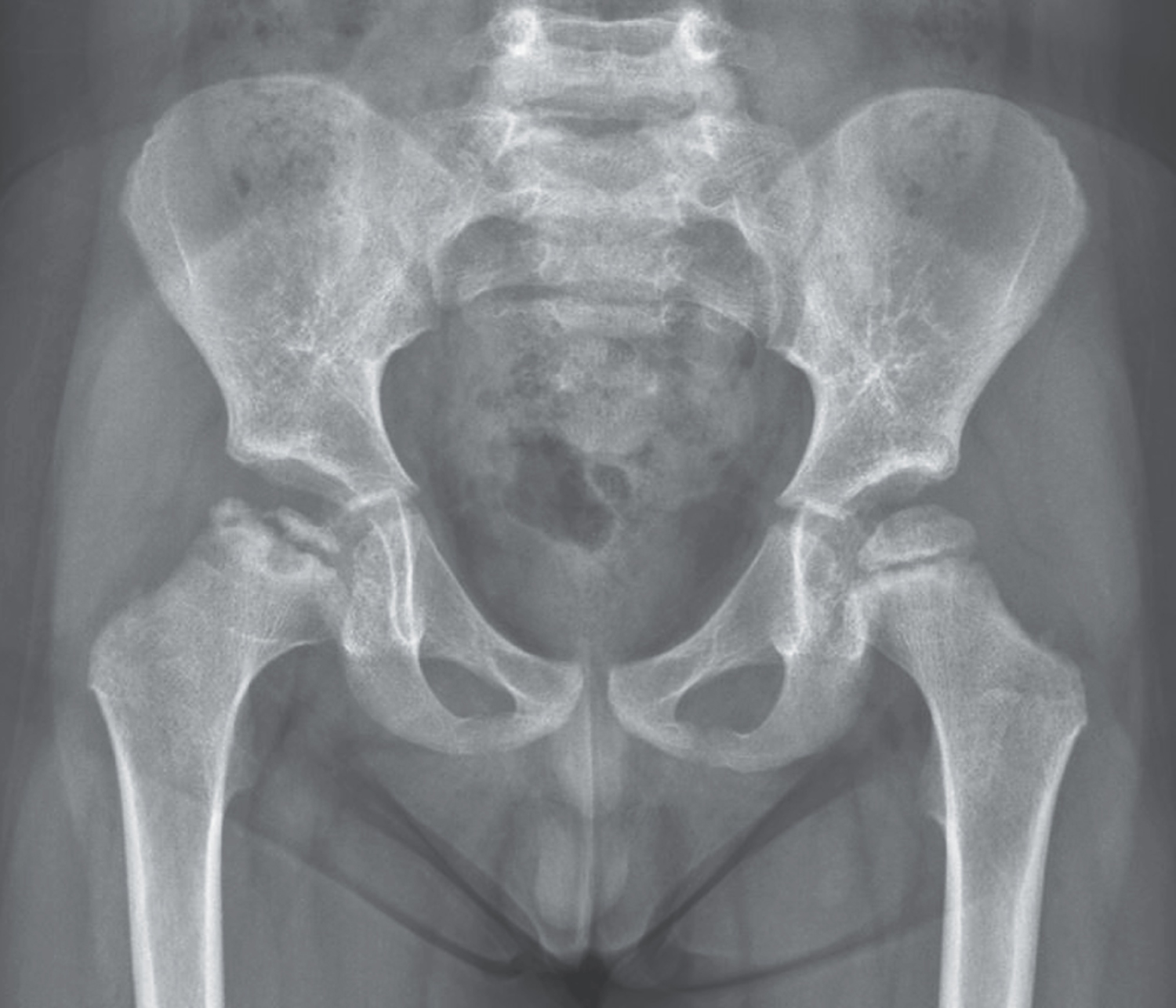 Legg–Calvé–Perthes disease