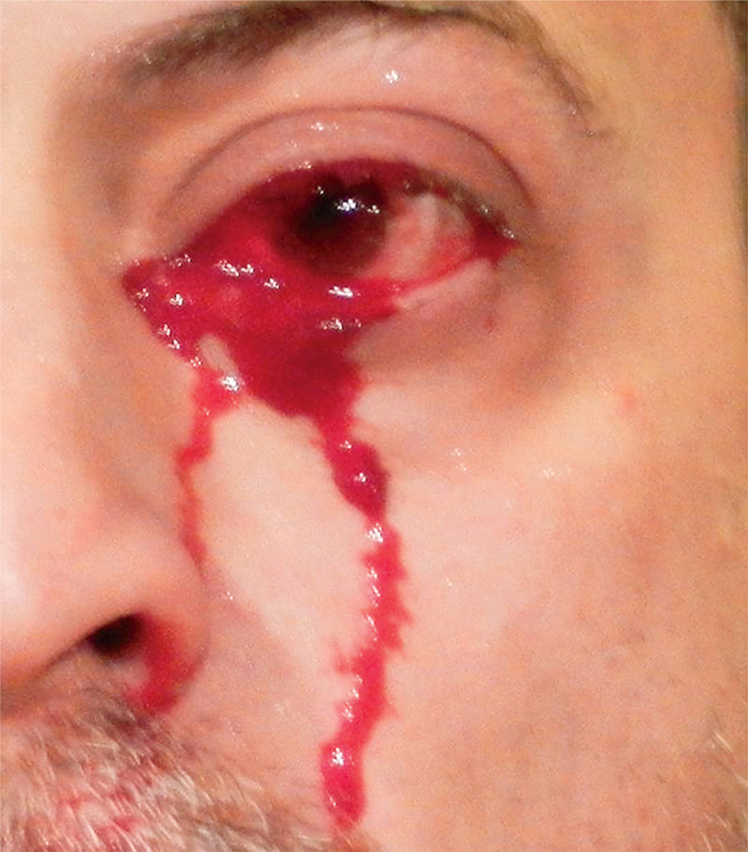 Adverse reaction to systemic antibiotics