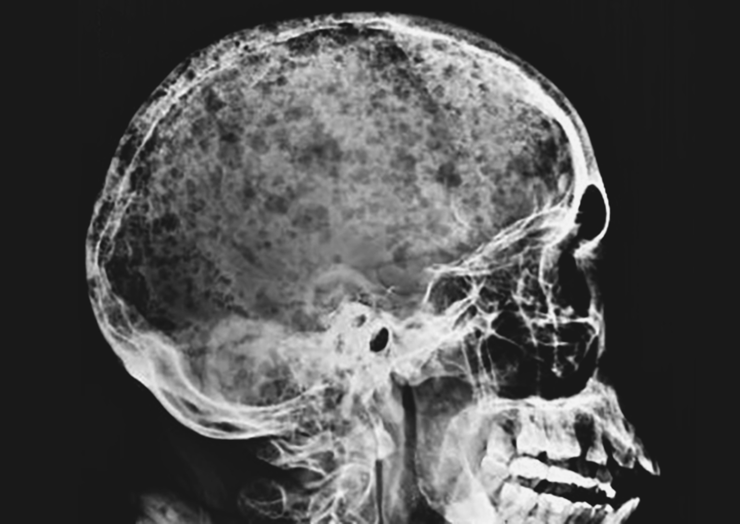 Multiple myeloma