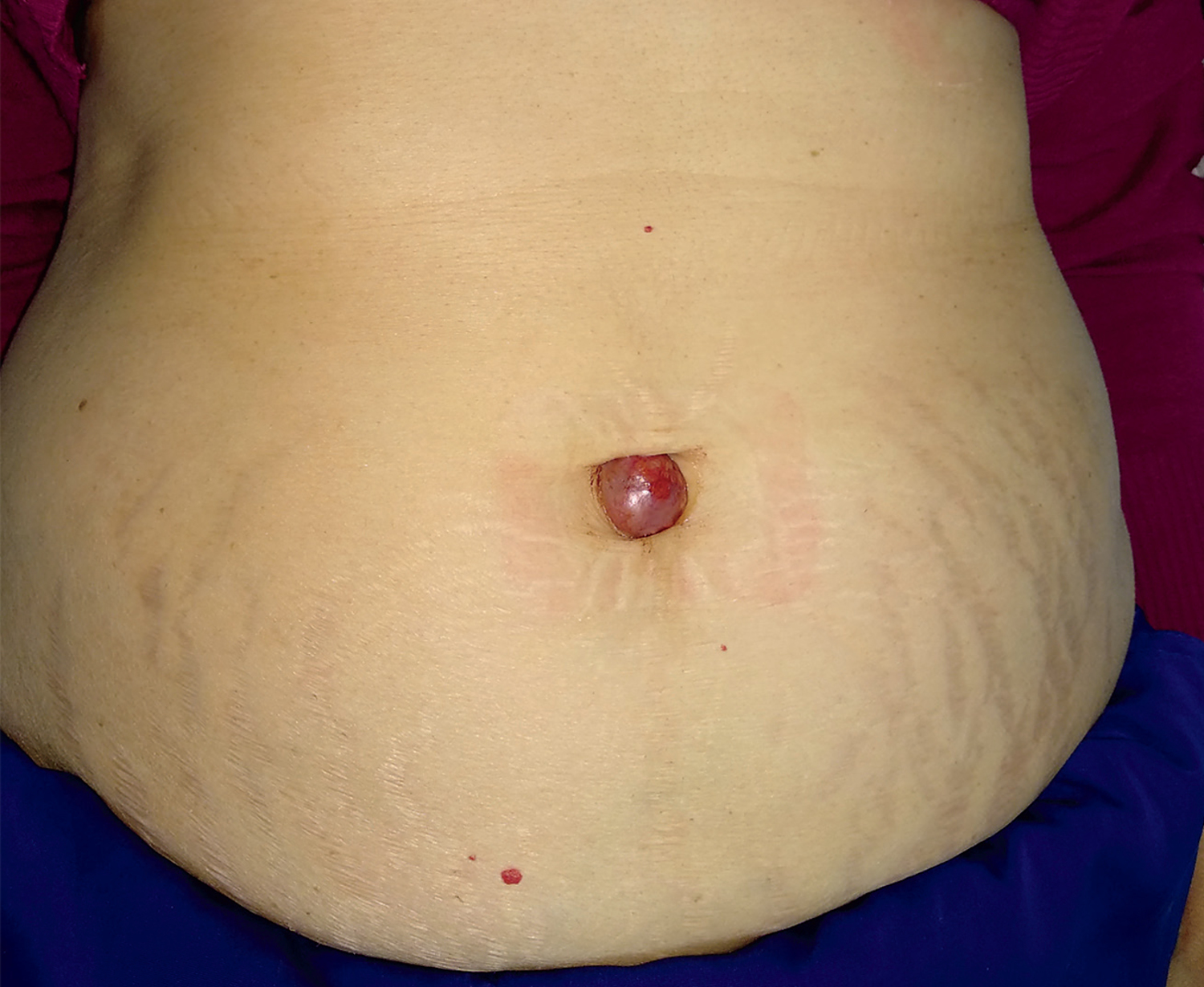 Sister Mary Joseph's nodule