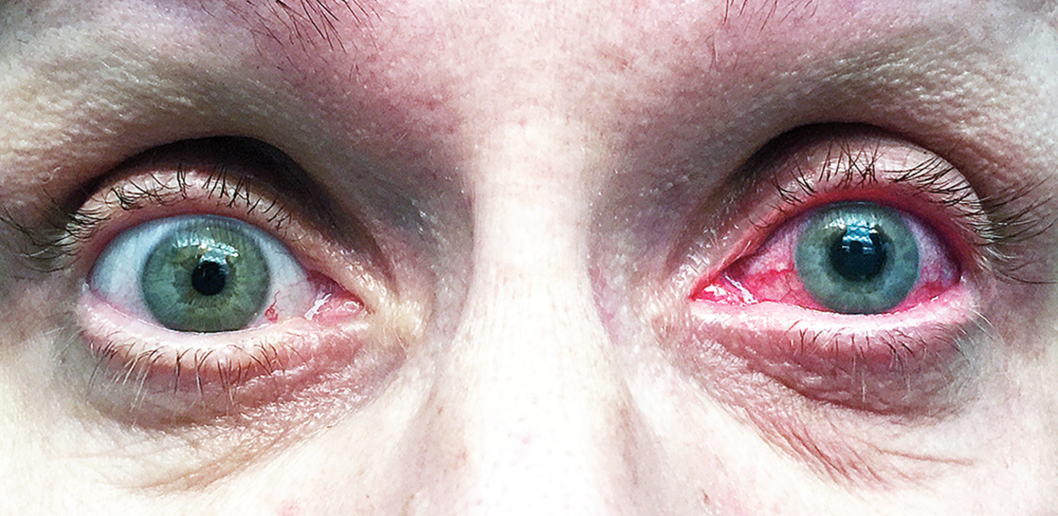 Acute angle-closure glaucoma
