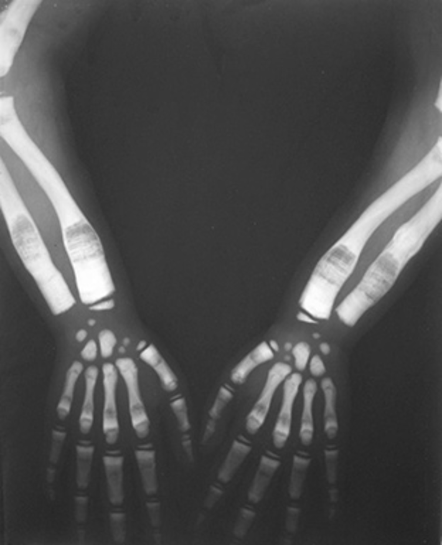 Osteopetrosis