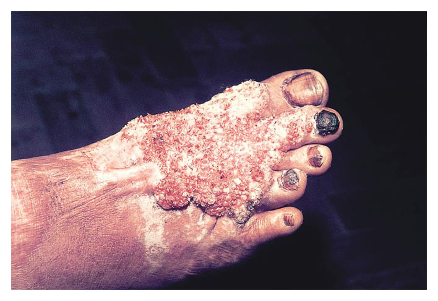 Chromoblastomycosis