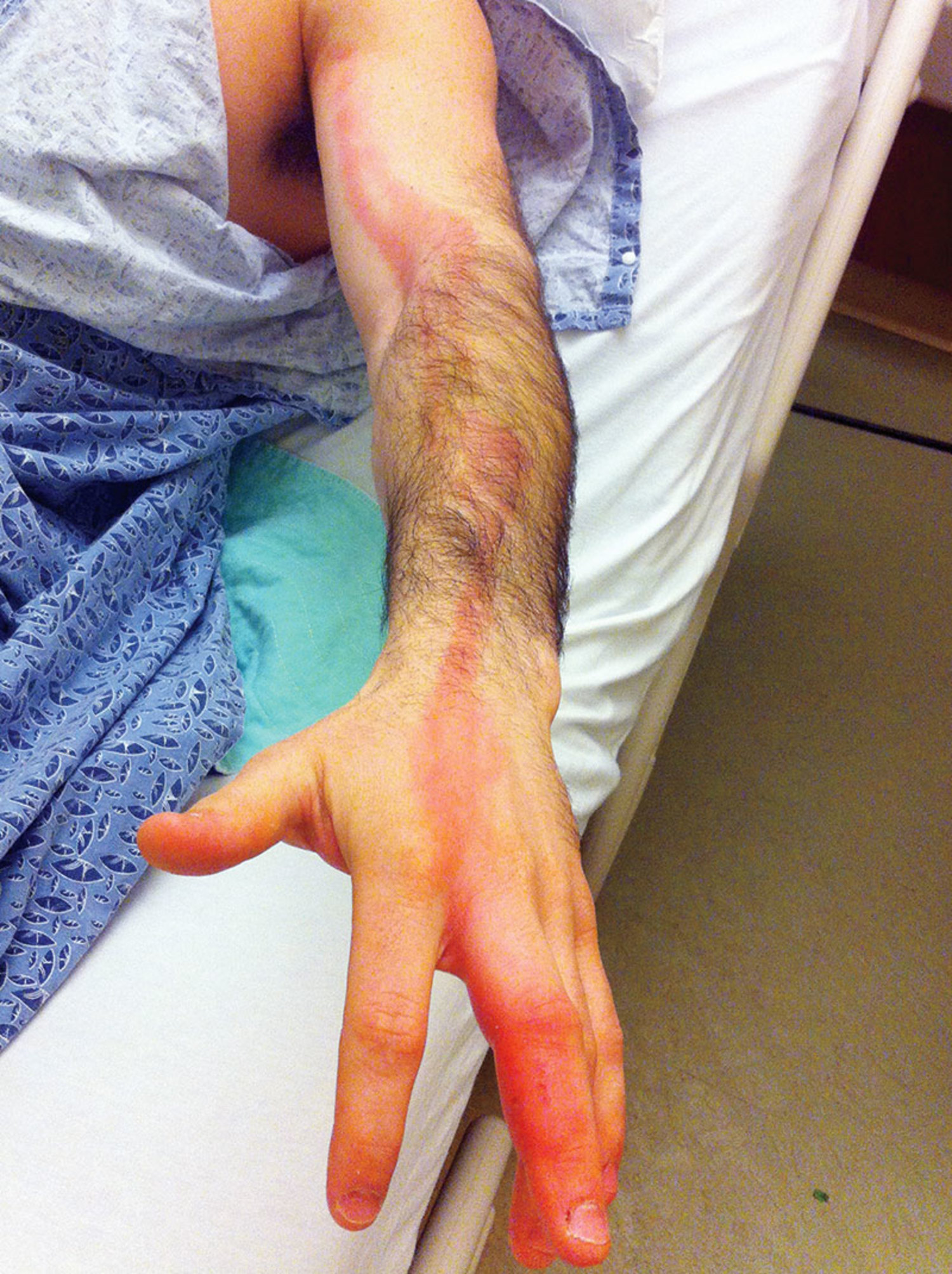 Acute lymphangitis